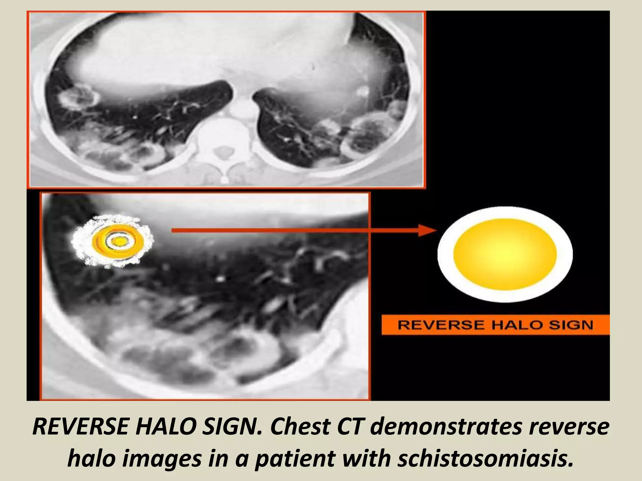 REVERSE HALO SIGN. Chest CT demonstrates reverse
halo images in a patient with schistosomiasis.
 