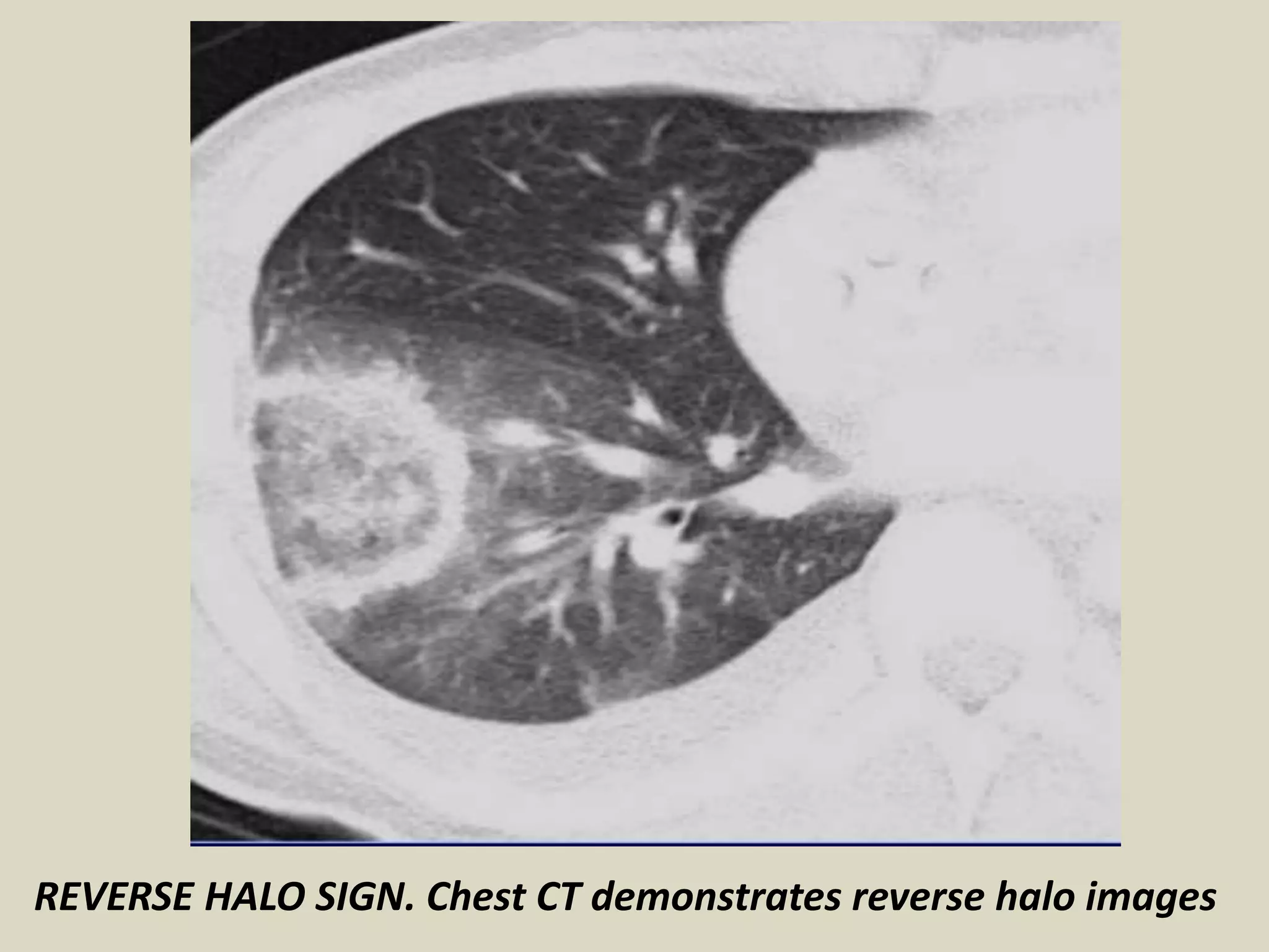 REVERSE HALO SIGN. Chest CT demonstrates reverse halo images
 
