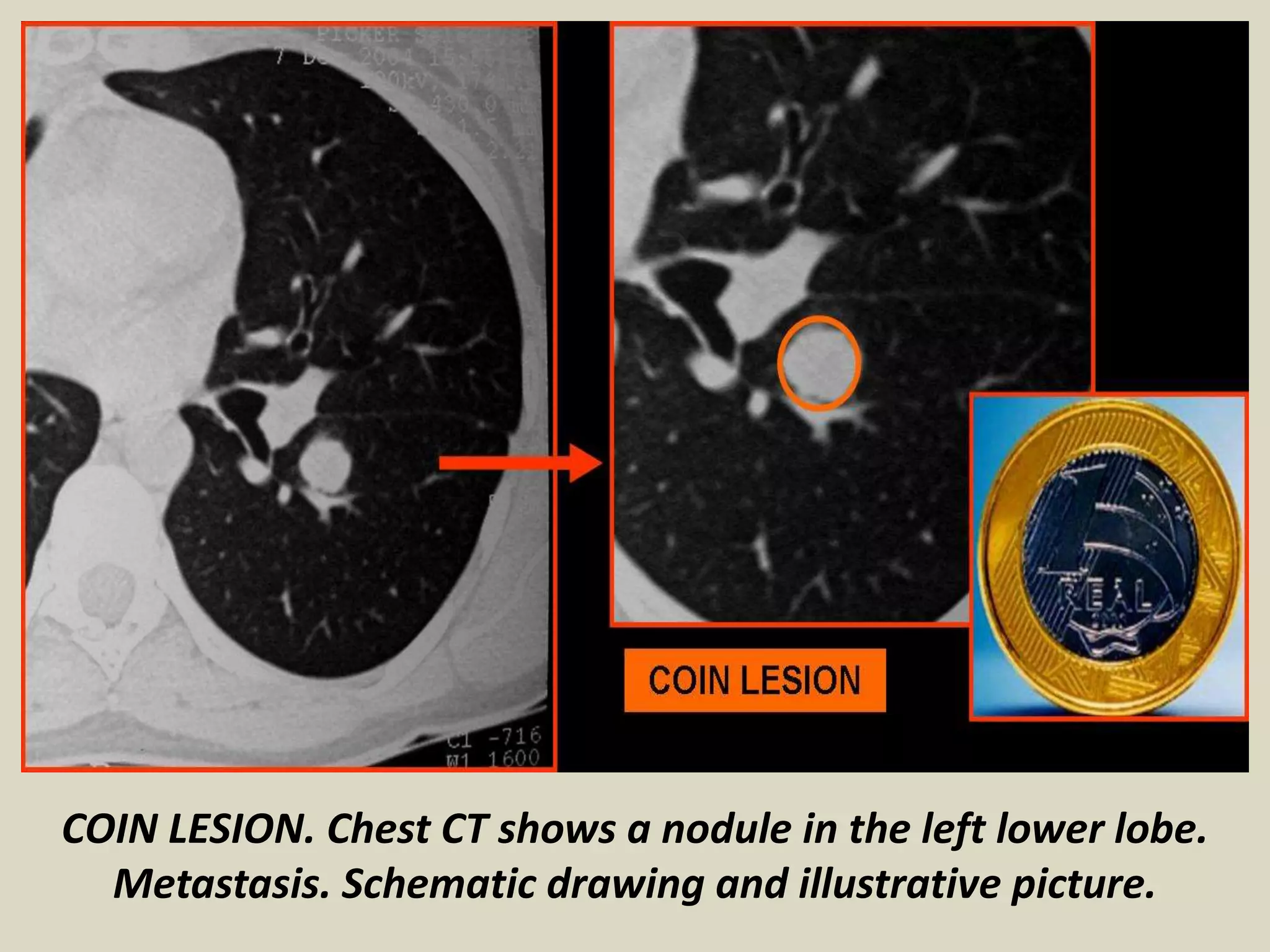 COIN LESION. Chest CT shows a nodule in the left lower lobe.
Metastasis. Schematic drawing and illustrative picture.
 