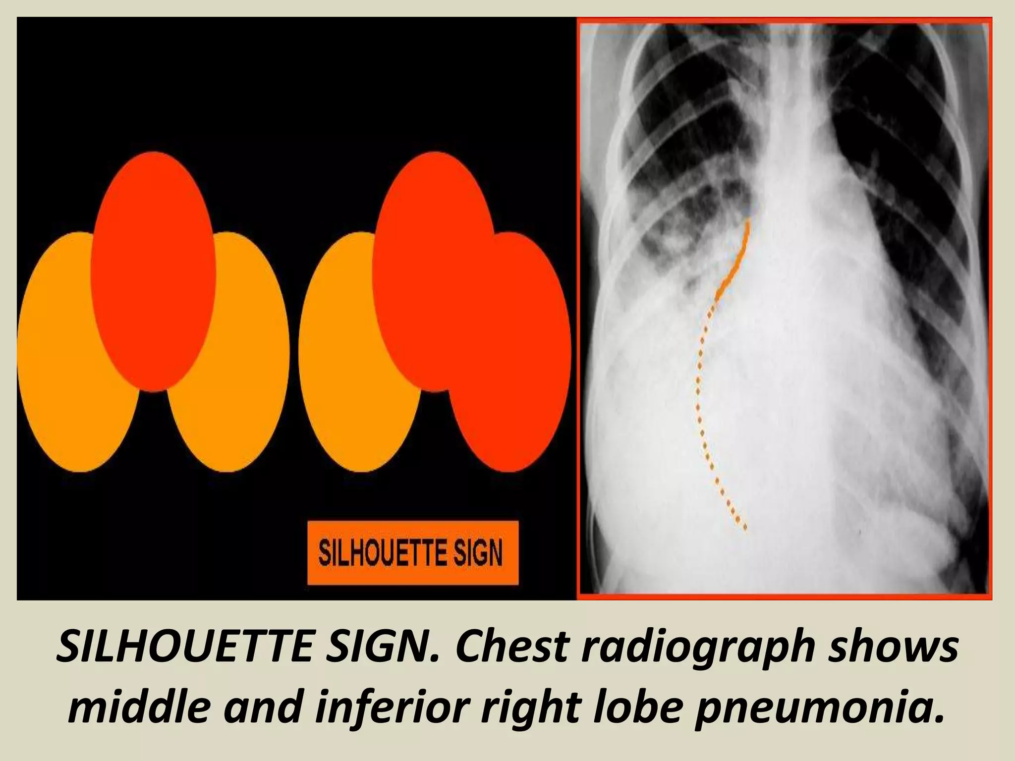SILHOUETTE SIGN. Chest radiograph shows
middle and inferior right lobe pneumonia.
 