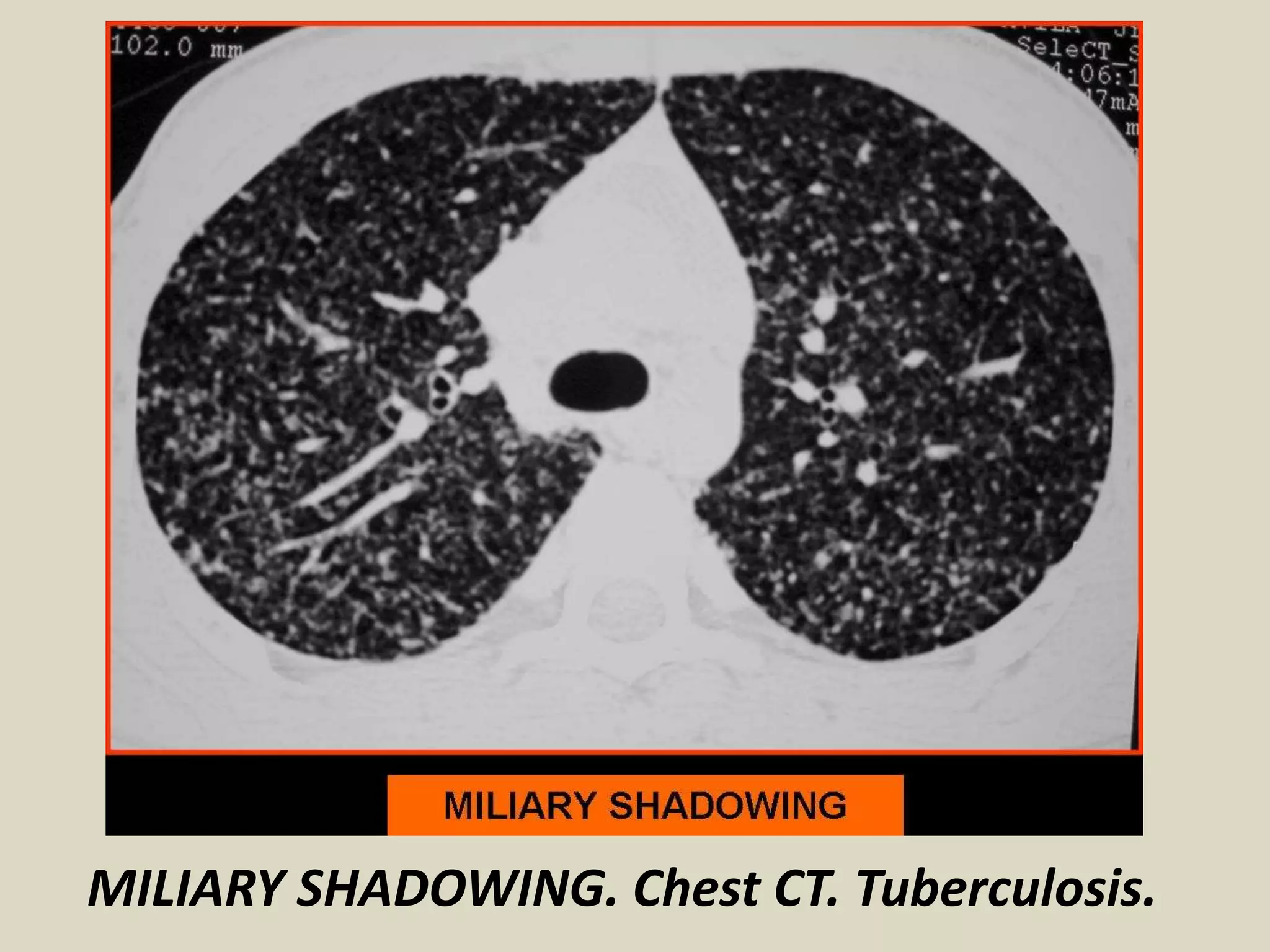 MILIARY SHADOWING. Chest CT. Tuberculosis.
 