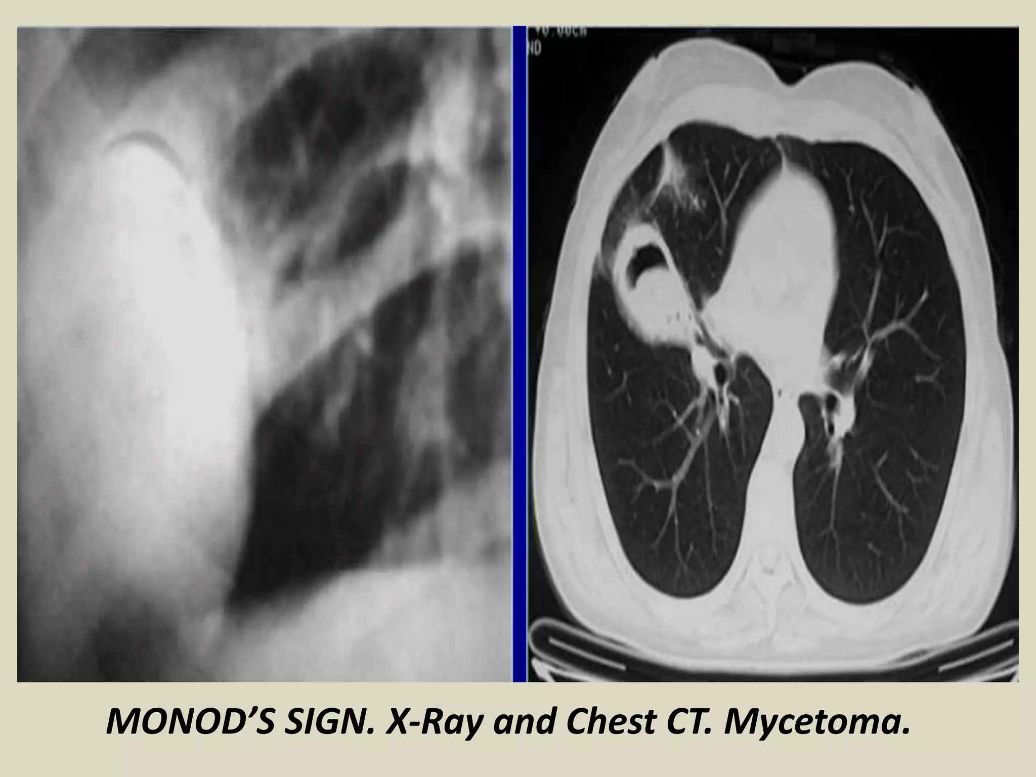MONOD’S SIGN. X-Ray and Chest CT. Mycetoma.
 