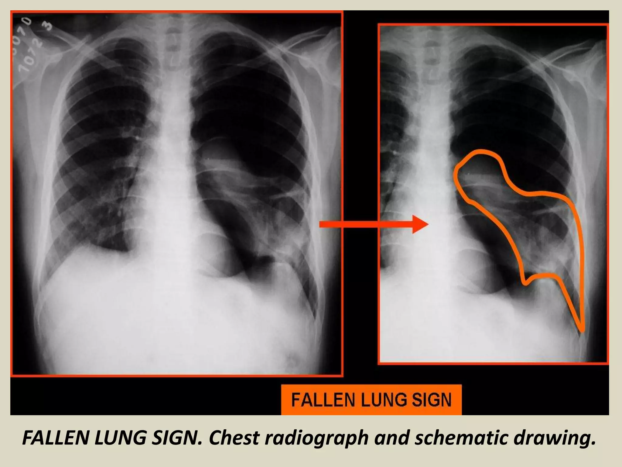 FALLEN LUNG SIGN. Chest radiograph and schematic drawing.
 