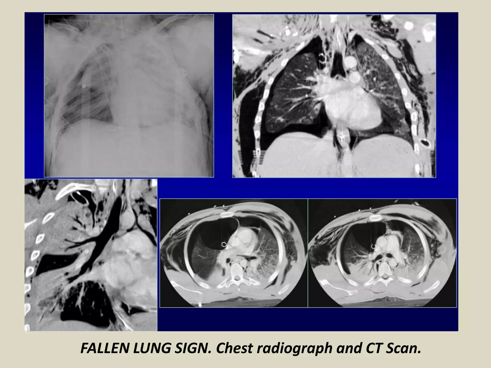 FALLEN LUNG SIGN. Chest radiograph and CT Scan.
 