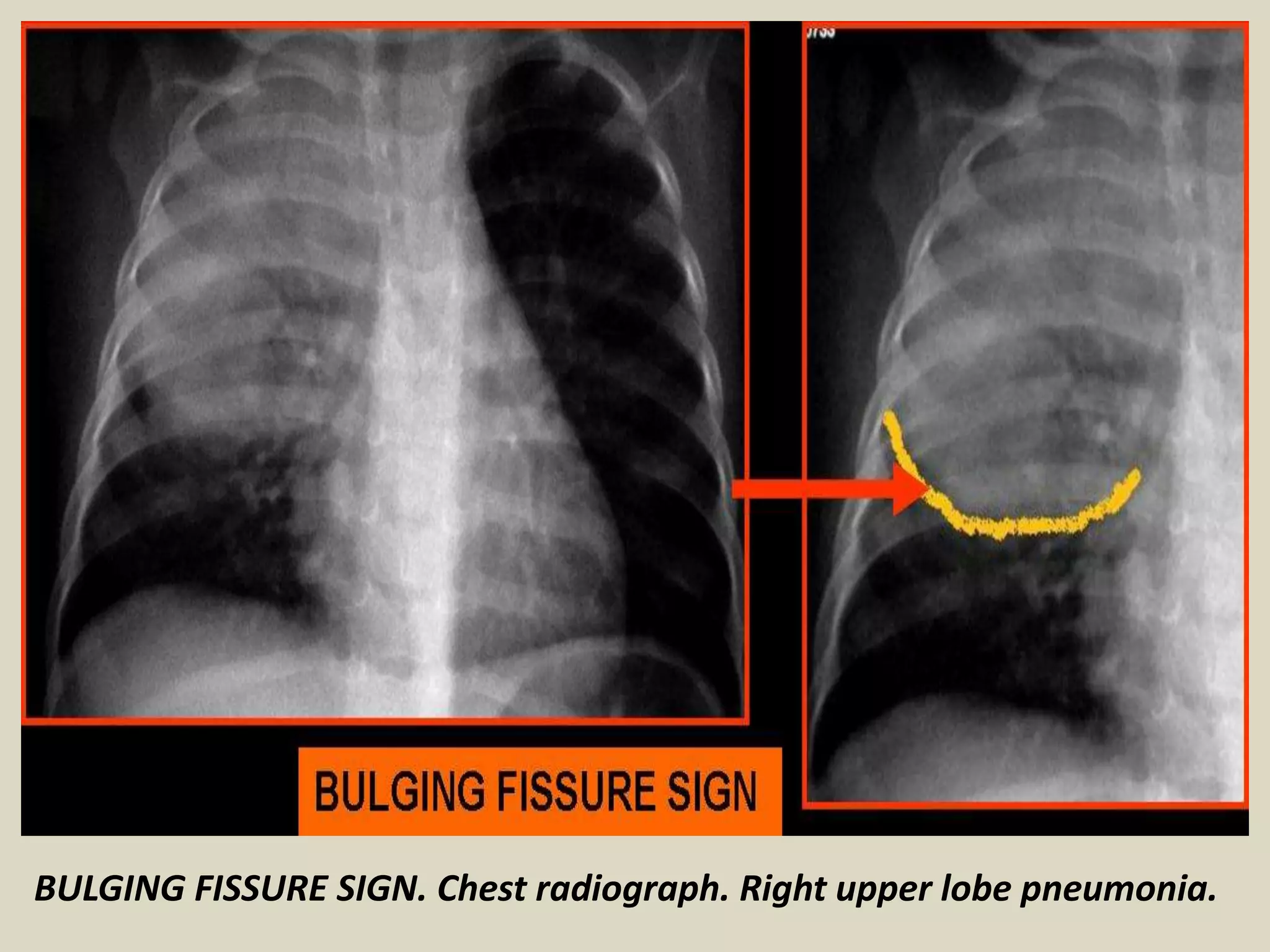 BULGING FISSURE SIGN. Chest radiograph. Right upper lobe pneumonia.
 
