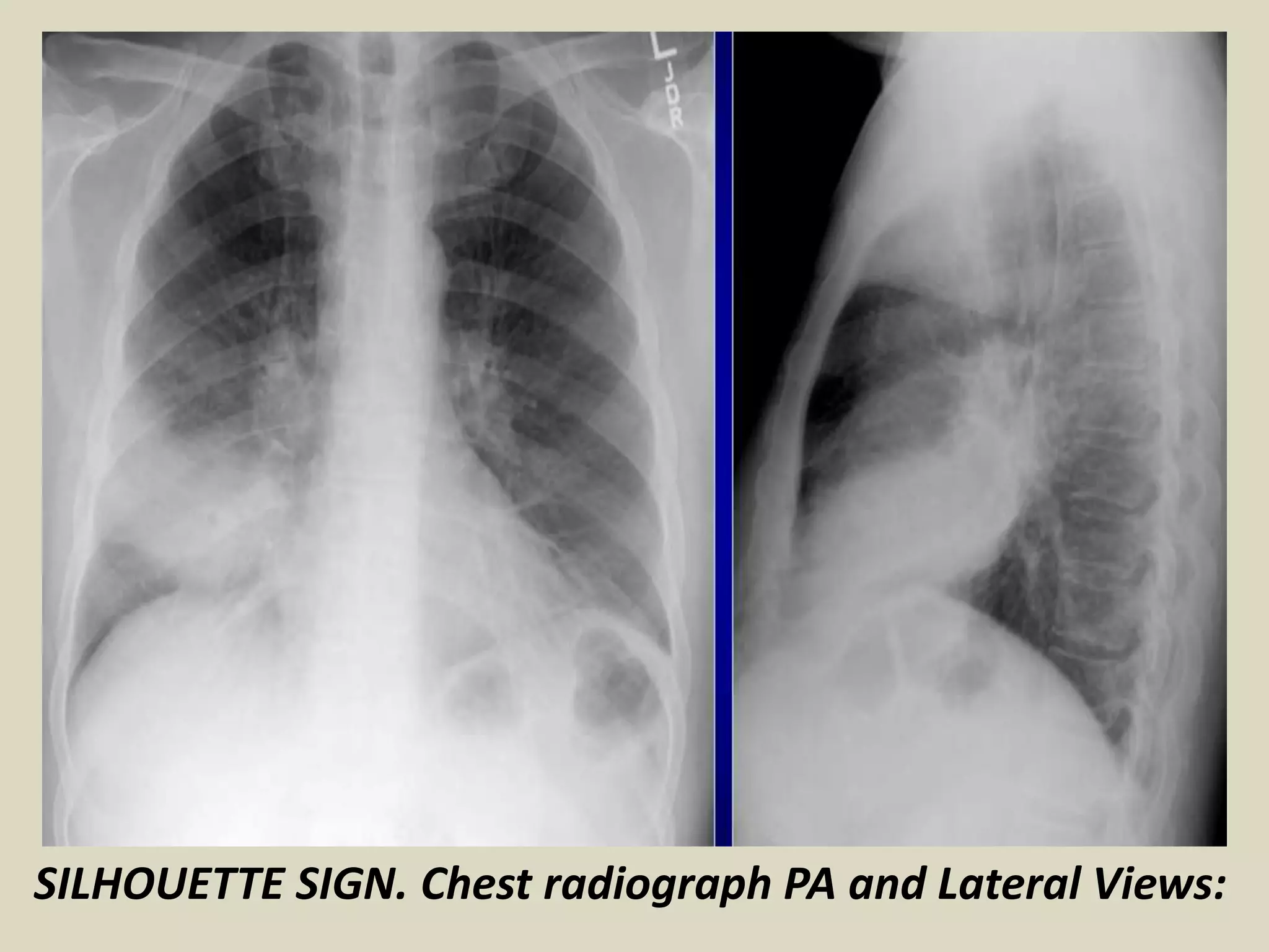 SILHOUETTE SIGN. Chest radiograph PA and Lateral Views:
 