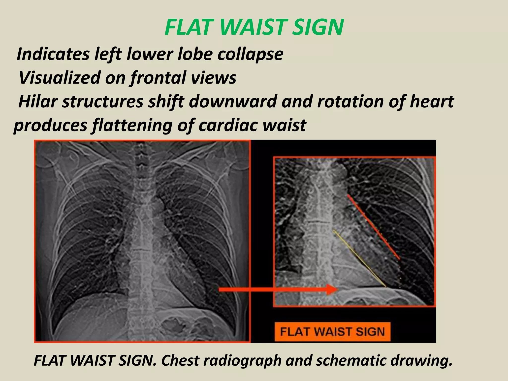 FLAT WAIST SIGN
Indicates left lower lobe collapse
Visualized on frontal views
Hilar structures shift downward and rotation of heart
produces flattening of cardiac waist
FLAT WAIST SIGN. Chest radiograph and schematic drawing.
 