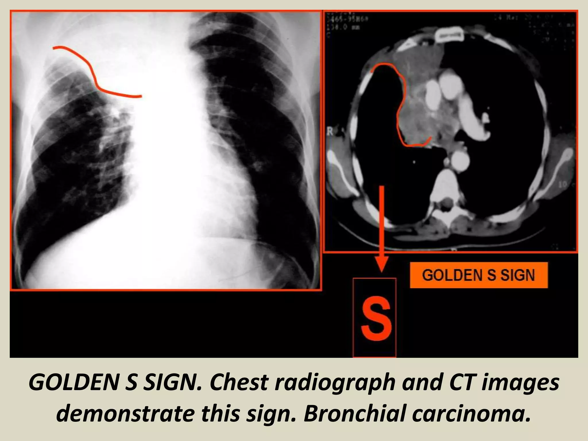 GOLDEN S SIGN. Chest radiograph and CT images
demonstrate this sign. Bronchial carcinoma.
 