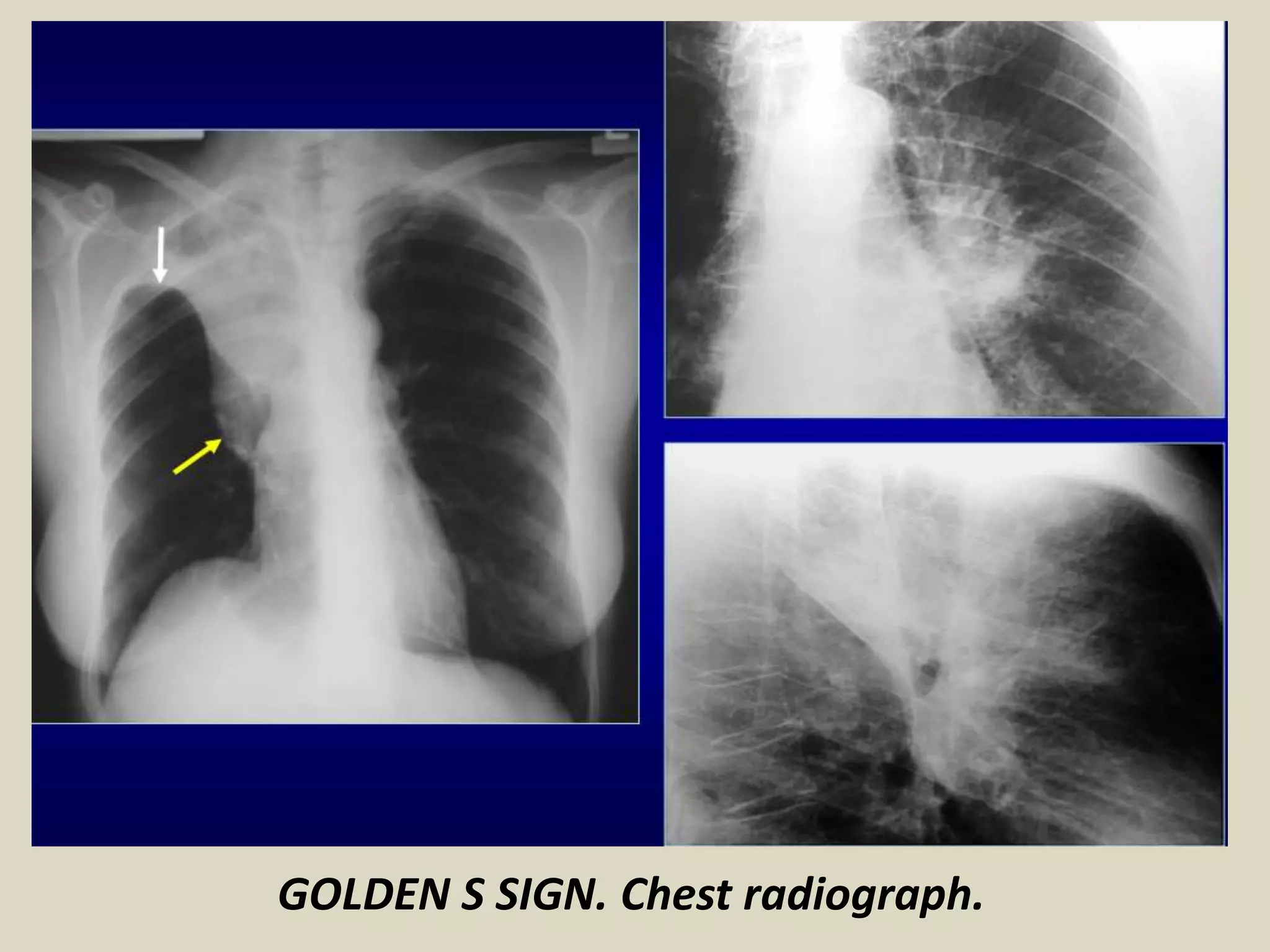 GOLDEN S SIGN. Chest radiograph.
 