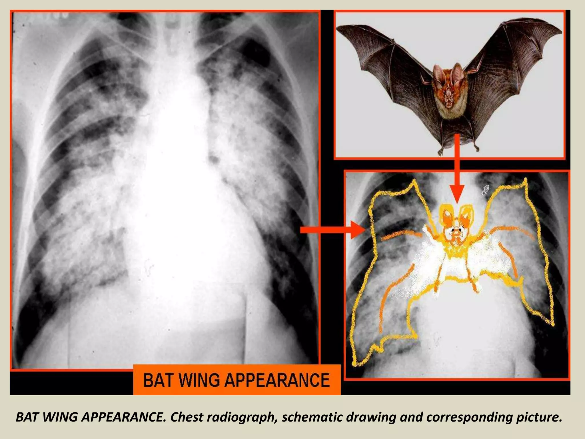 BAT WING APPEARANCE. Chest radiograph, schematic drawing and corresponding picture.
 
