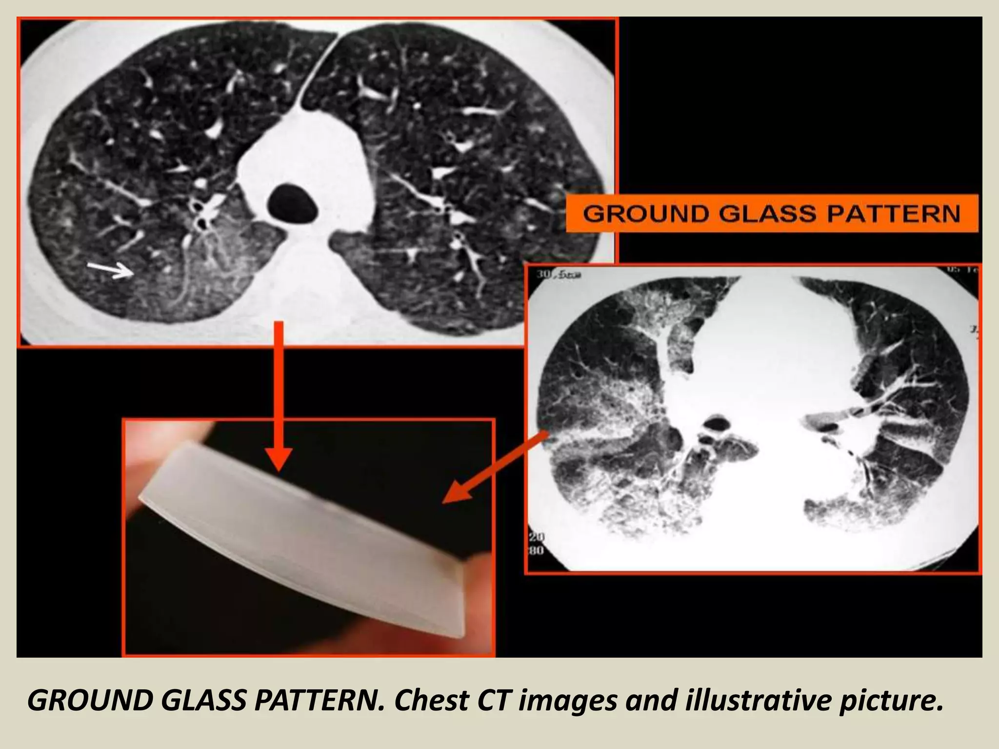 GROUND GLASS PATTERN. Chest CT images and illustrative picture.
 