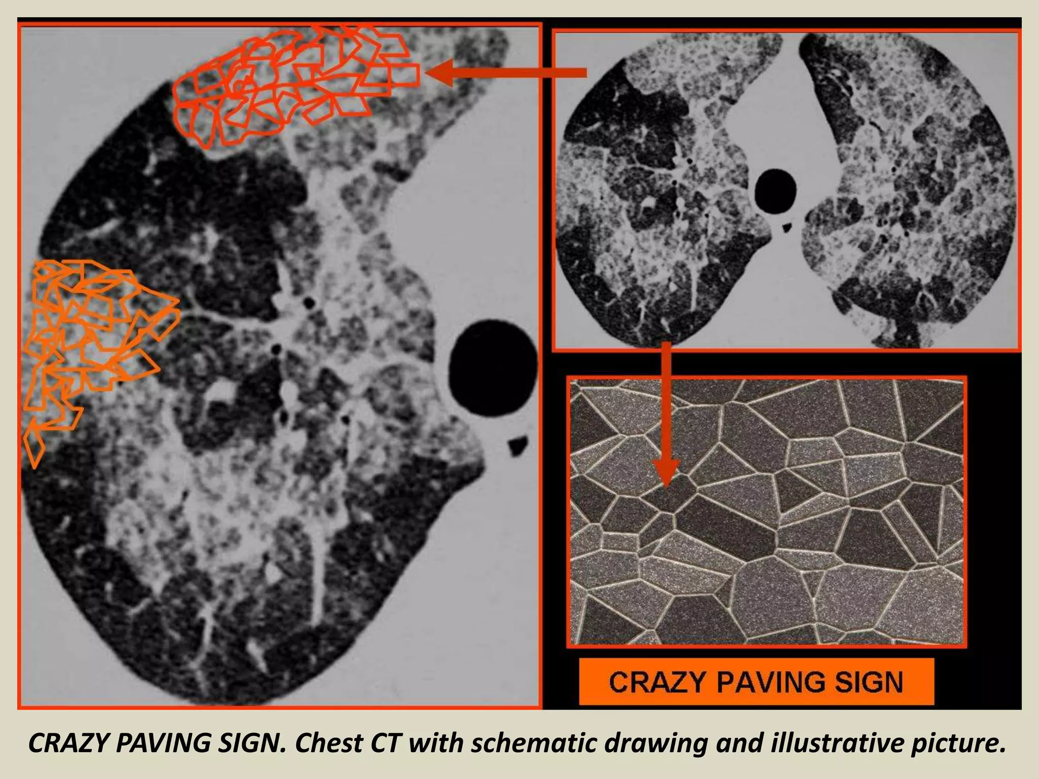 CRAZY PAVING SIGN. Chest CT with schematic drawing and illustrative picture.
 