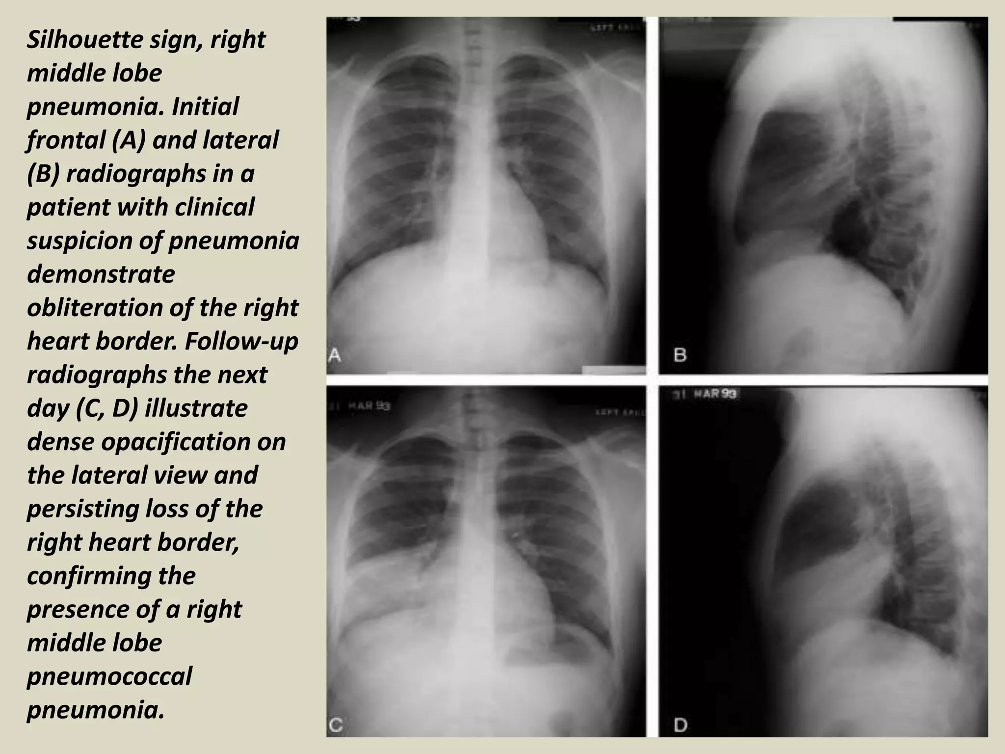 Silhouette sign, right
middle lobe
pneumonia. Initial
frontal (A) and lateral
(B) radiographs in a
patient with clinical
suspicion of pneumonia
demonstrate
obliteration of the right
heart border. Follow-up
radiographs the next
day (C, D) illustrate
dense opacification on
the lateral view and
persisting loss of the
right heart border,
confirming the
presence of a right
middle lobe
pneumococcal
pneumonia.
 