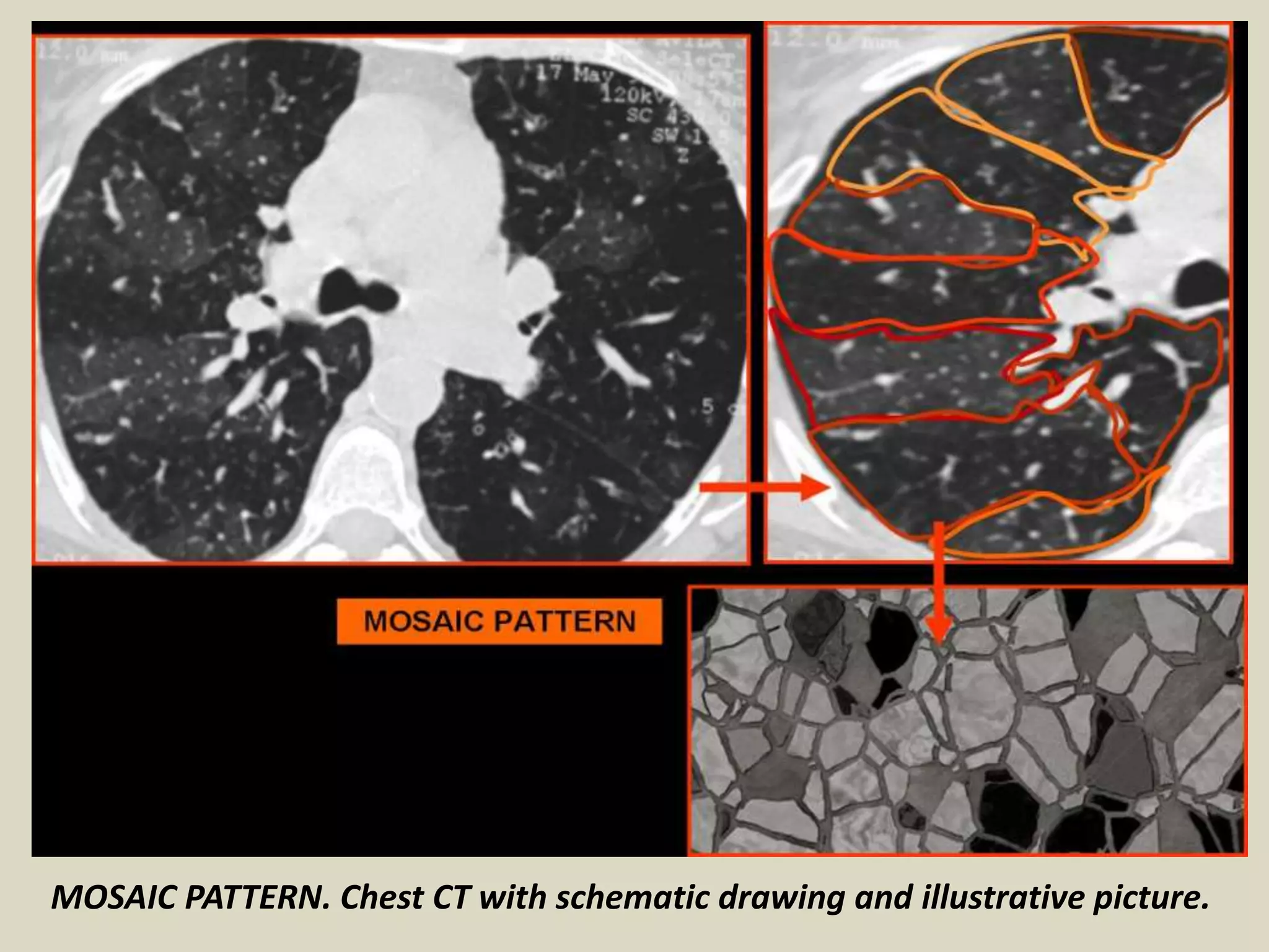 MOSAIC PATTERN. Chest CT with schematic drawing and illustrative picture.
 