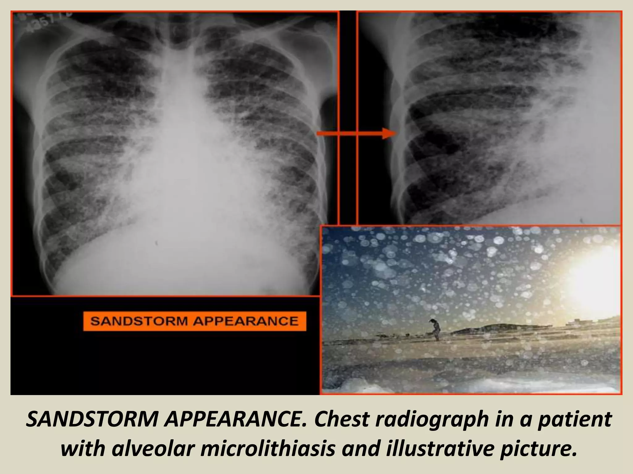 SANDSTORM APPEARANCE. Chest radiograph in a patient
with alveolar microlithiasis and illustrative picture.
 