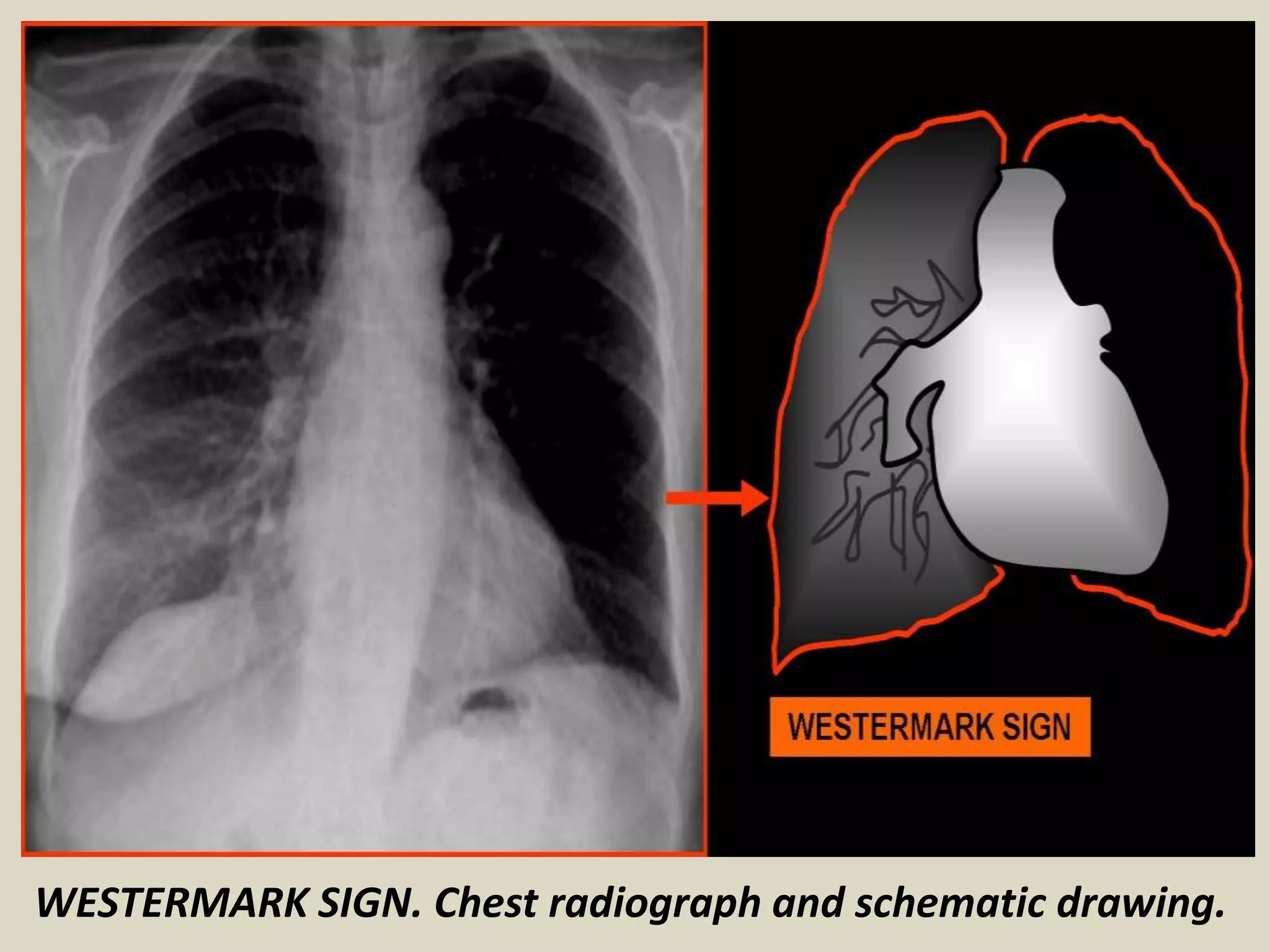 WESTERMARK SIGN. Chest radiograph and schematic drawing.
 