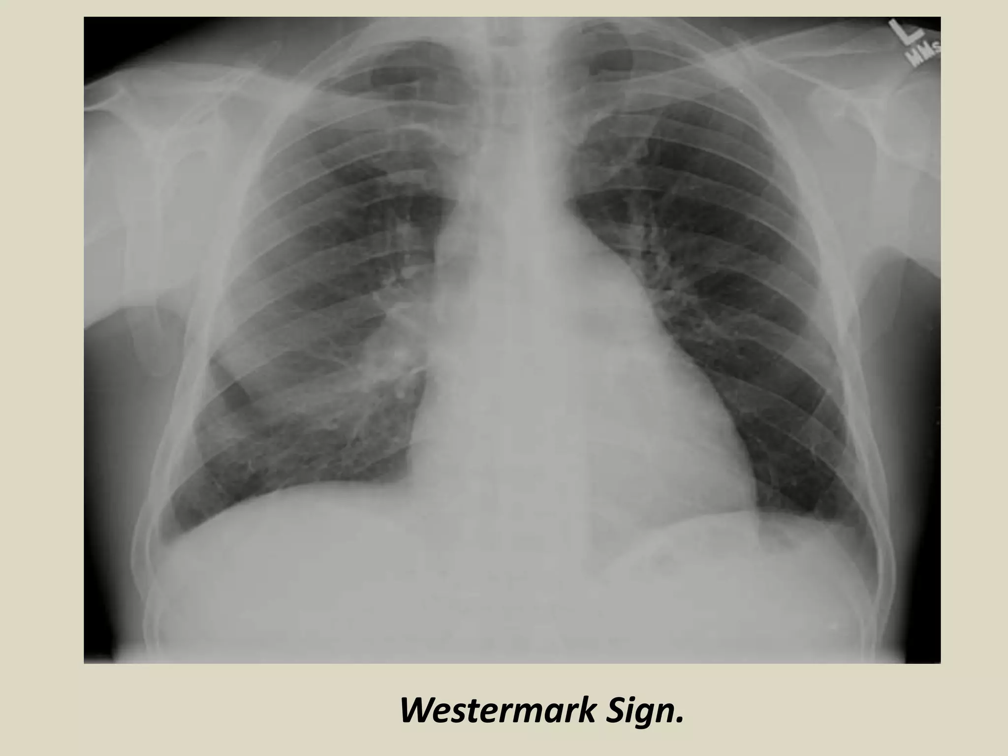 Westermark Sign.
 
