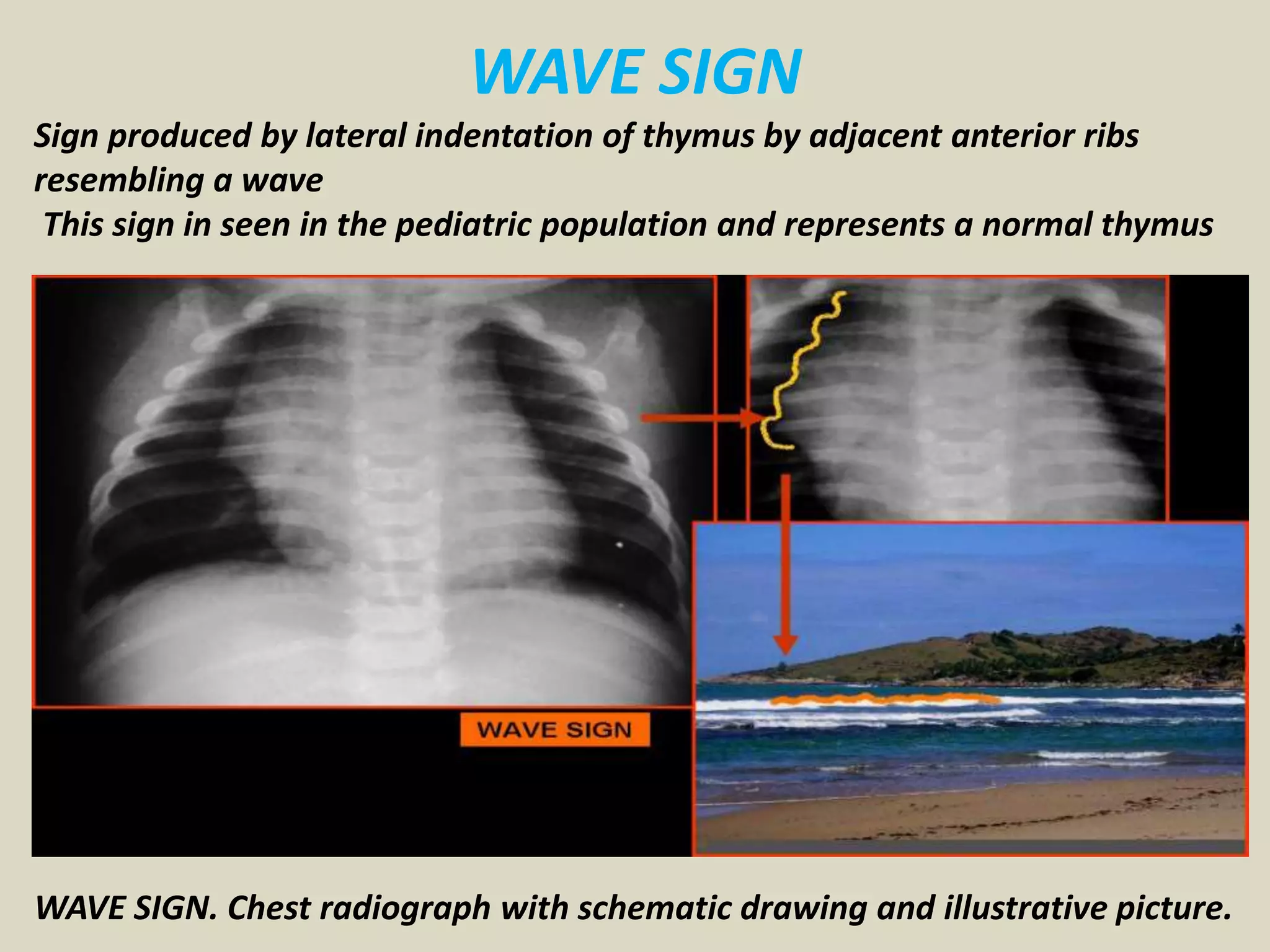 WAVE SIGN
Sign produced by lateral indentation of thymus by adjacent anterior ribs
resembling a wave
This sign in seen in the pediatric population and represents a normal thymus
WAVE SIGN. Chest radiograph with schematic drawing and illustrative picture.
 