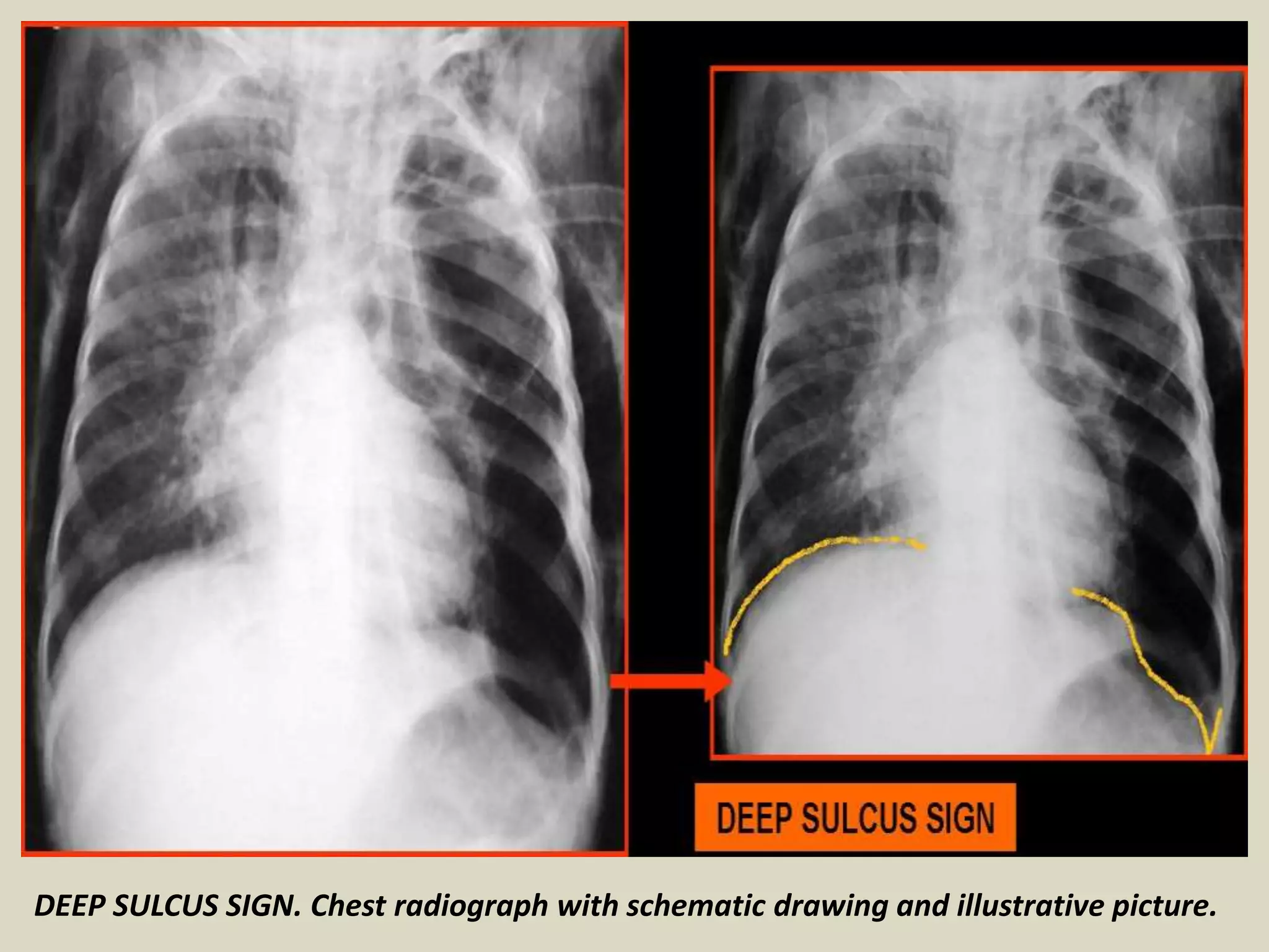 DEEP SULCUS SIGN. Chest radiograph with schematic drawing and illustrative picture.
 