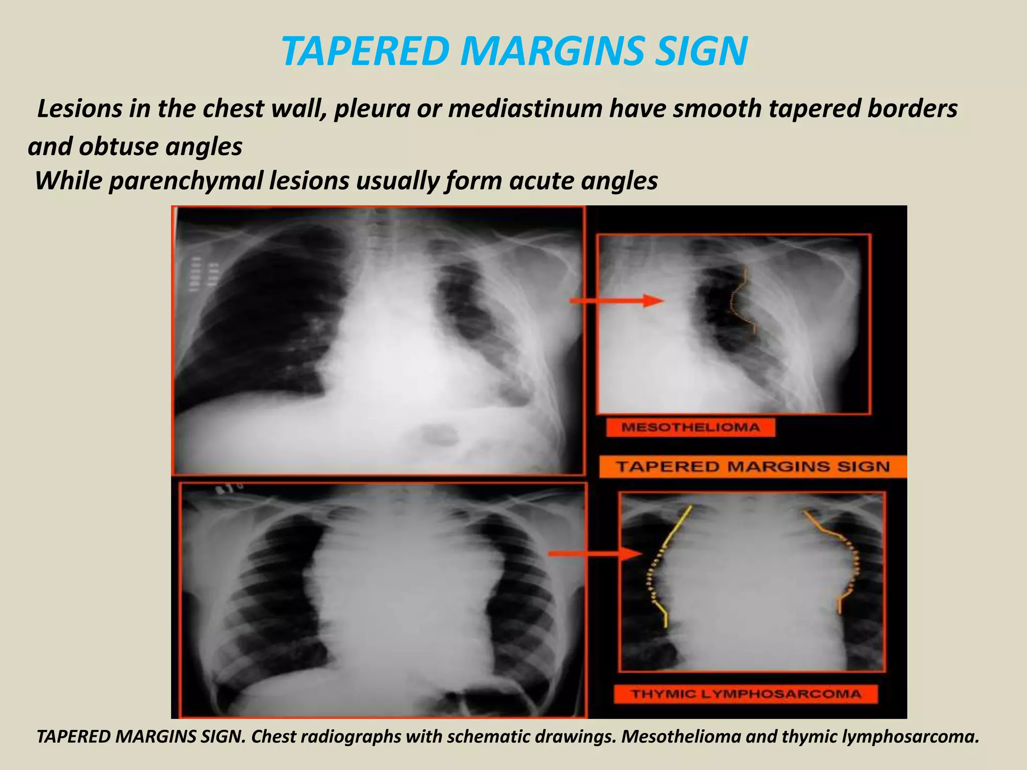 TAPERED MARGINS SIGN
Lesions in the chest wall, pleura or mediastinum have smooth tapered borders
and obtuse angles
While parenchymal lesions usually form acute angles
TAPERED MARGINS SIGN. Chest radiographs with schematic drawings. Mesothelioma and thymic lymphosarcoma.
 