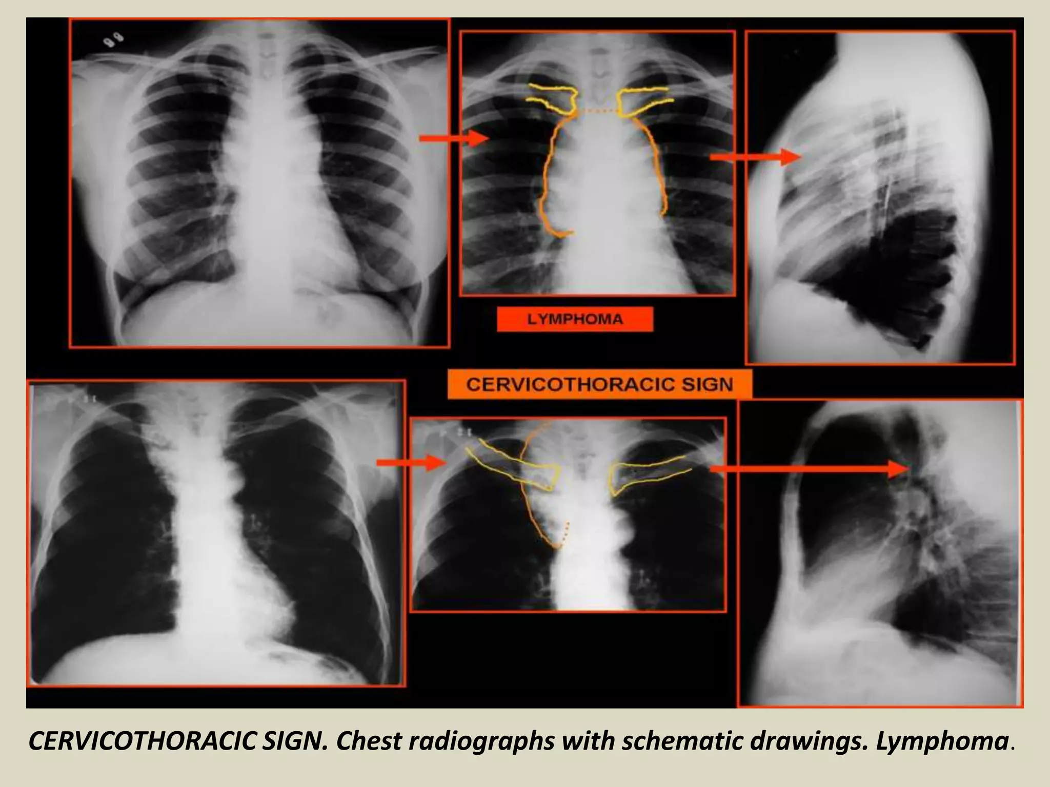 CERVICOTHORACIC SIGN. Chest radiographs with schematic drawings. Lymphoma.
 