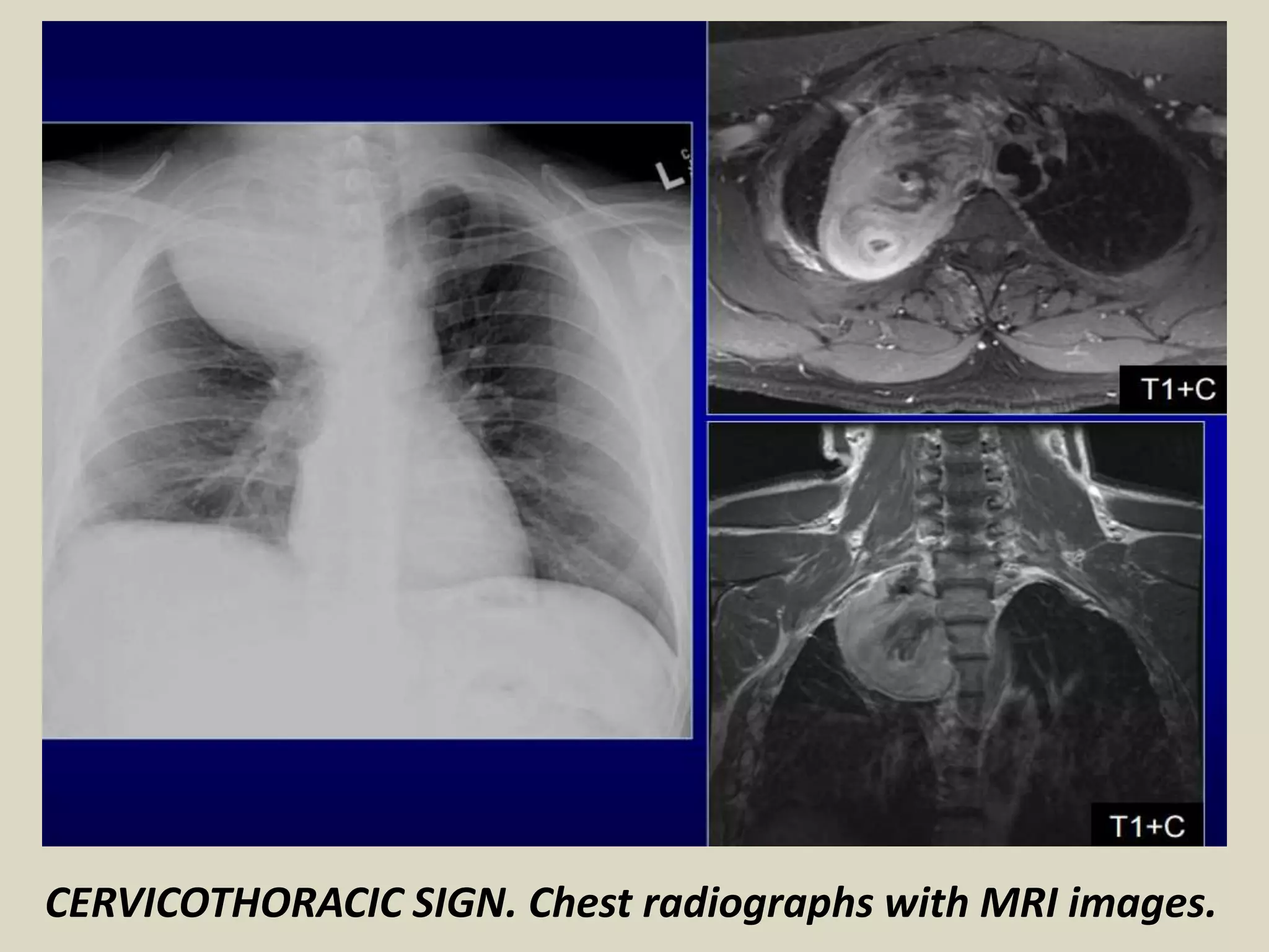CERVICOTHORACIC SIGN. Chest radiographs with MRI images.
 