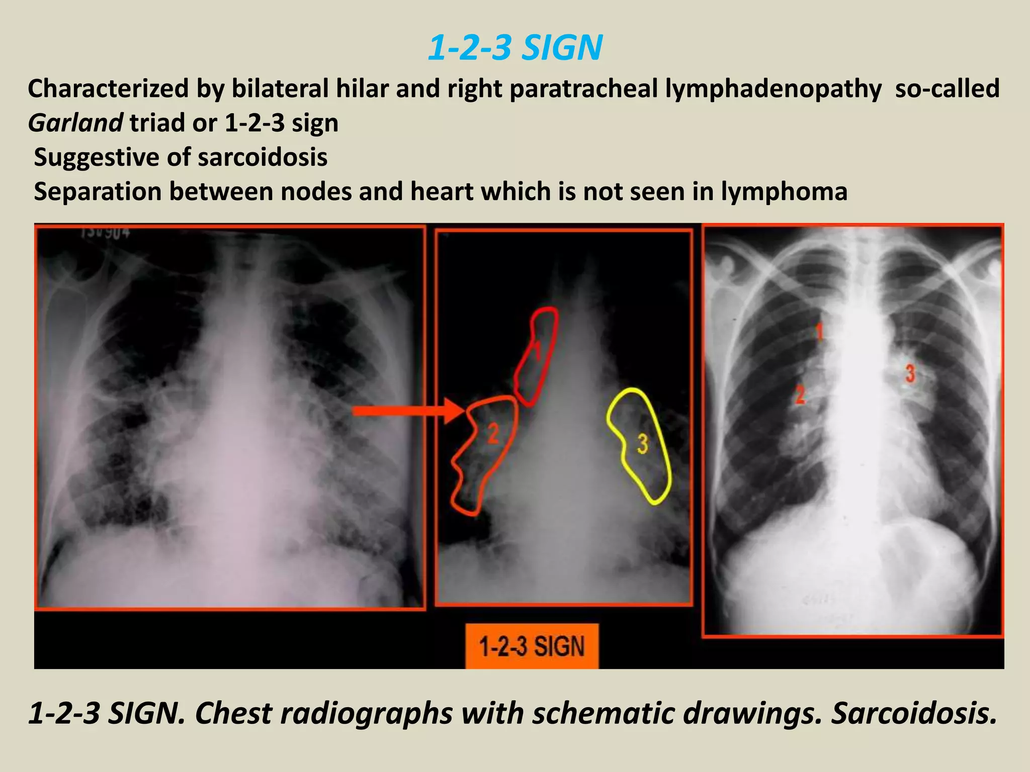 1-2-3 SIGN
Characterized by bilateral hilar and right paratracheal lymphadenopathy so-called
Garland triad or 1-2-3 sign
Suggestive of sarcoidosis
Separation between nodes and heart which is not seen in lymphoma
1-2-3 SIGN. Chest radiographs with schematic drawings. Sarcoidosis.
 