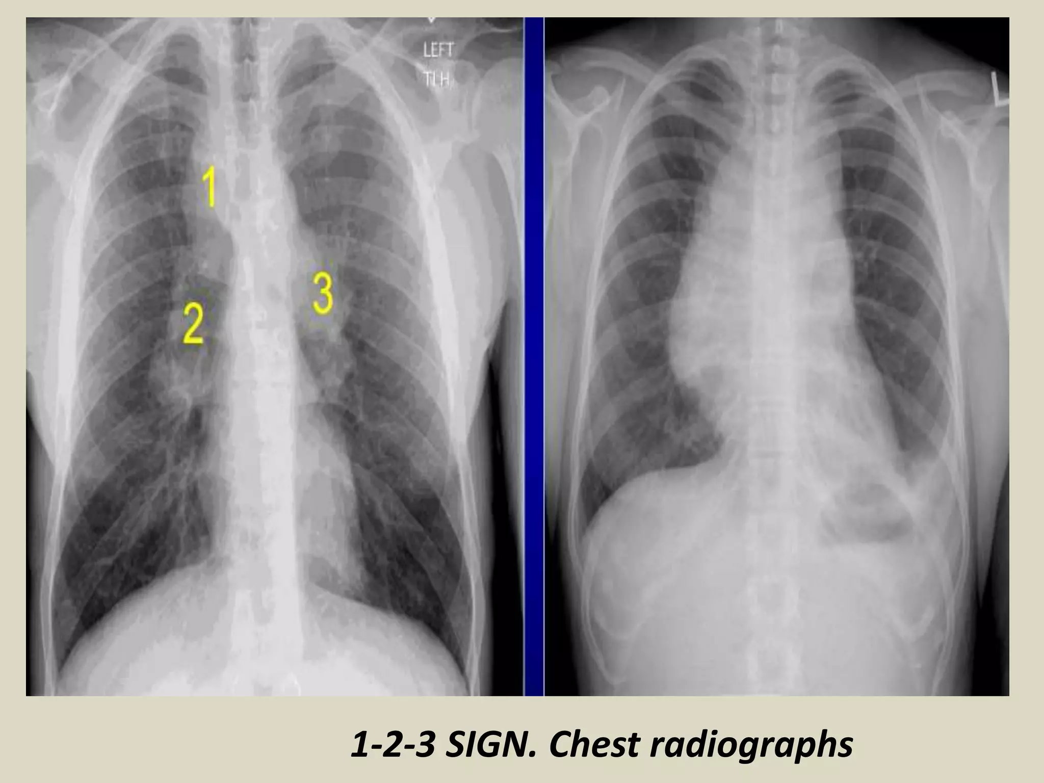 1-2-3 SIGN. Chest radiographs
 