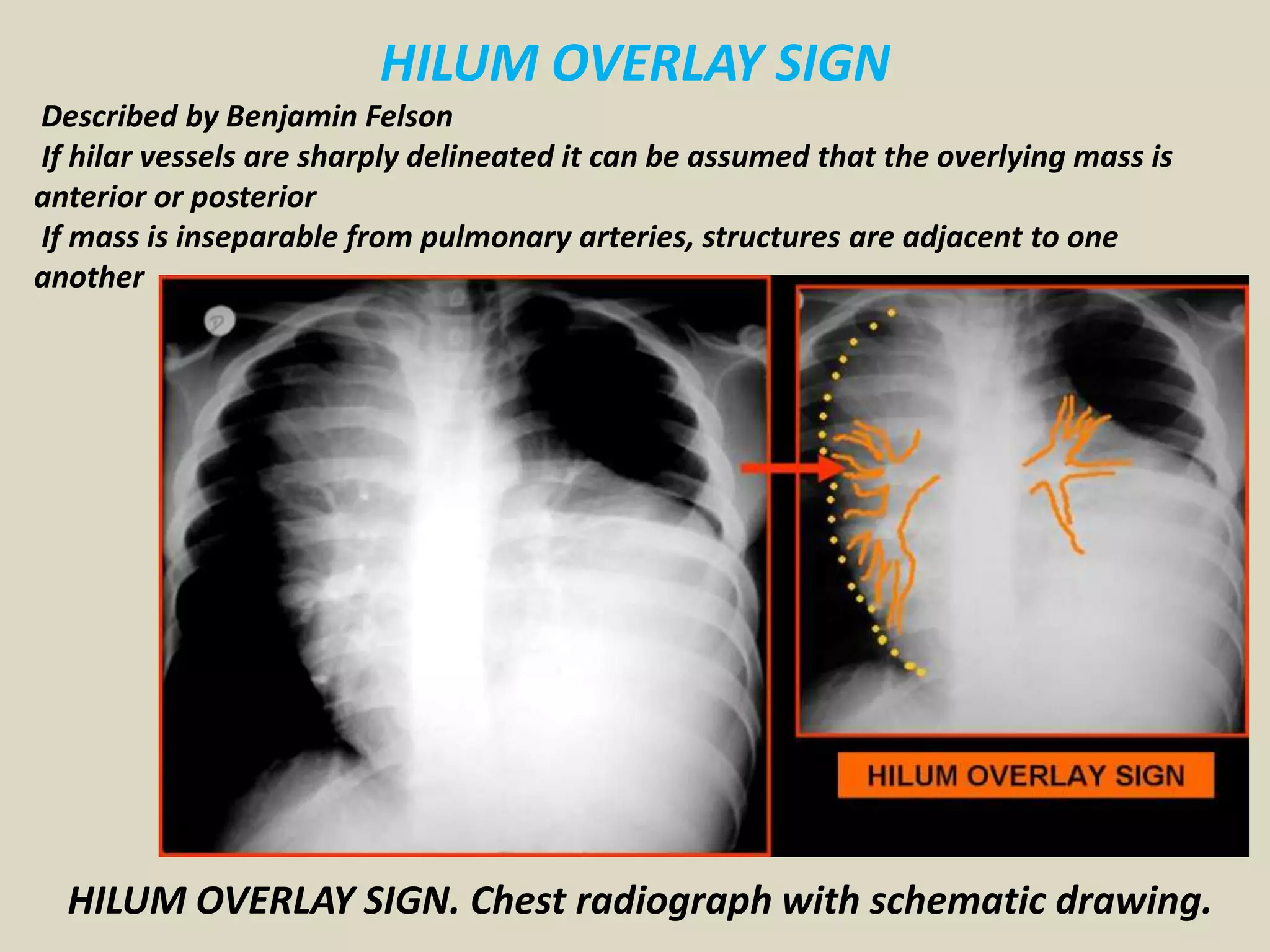 HILUM OVERLAY SIGN
Described by Benjamin Felson
If hilar vessels are sharply delineated it can be assumed that the overlying mass is
anterior or posterior
If mass is inseparable from pulmonary arteries, structures are adjacent to one
another
HILUM OVERLAY SIGN. Chest radiograph with schematic drawing.
 