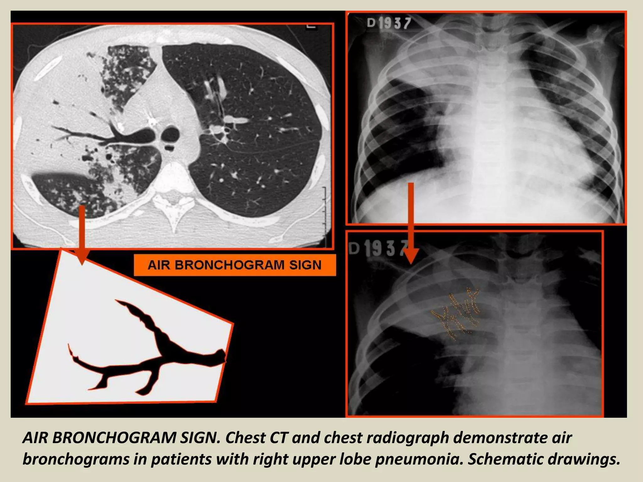 AIR BRONCHOGRAM SIGN. Chest CT and chest radiograph demonstrate air
bronchograms in patients with right upper lobe pneumonia. Schematic drawings.
 