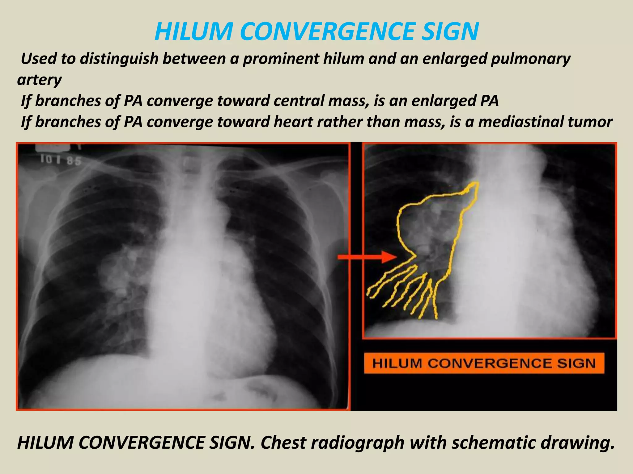 HILUM CONVERGENCE SIGN
Used to distinguish between a prominent hilum and an enlarged pulmonary
artery
If branches of PA converge toward central mass, is an enlarged PA
If branches of PA converge toward heart rather than mass, is a mediastinal tumor
HILUM CONVERGENCE SIGN. Chest radiograph with schematic drawing.
 