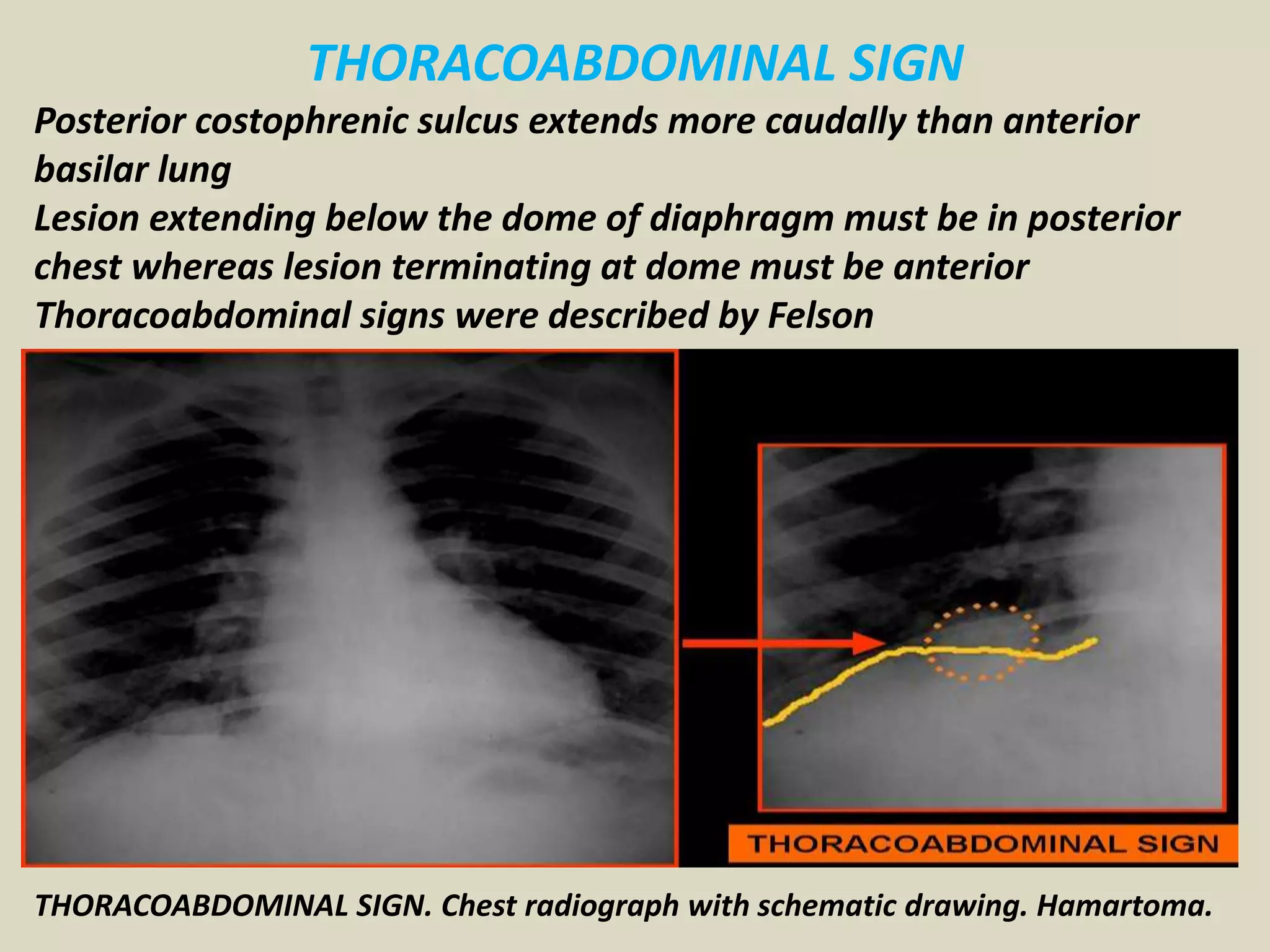 THORACOABDOMINAL SIGN
Posterior costophrenic sulcus extends more caudally than anterior
basilar lung
Lesion extending below the dome of diaphragm must be in posterior
chest whereas lesion terminating at dome must be anterior
Thoracoabdominal signs were described by Felson
THORACOABDOMINAL SIGN. Chest radiograph with schematic drawing. Hamartoma.
 