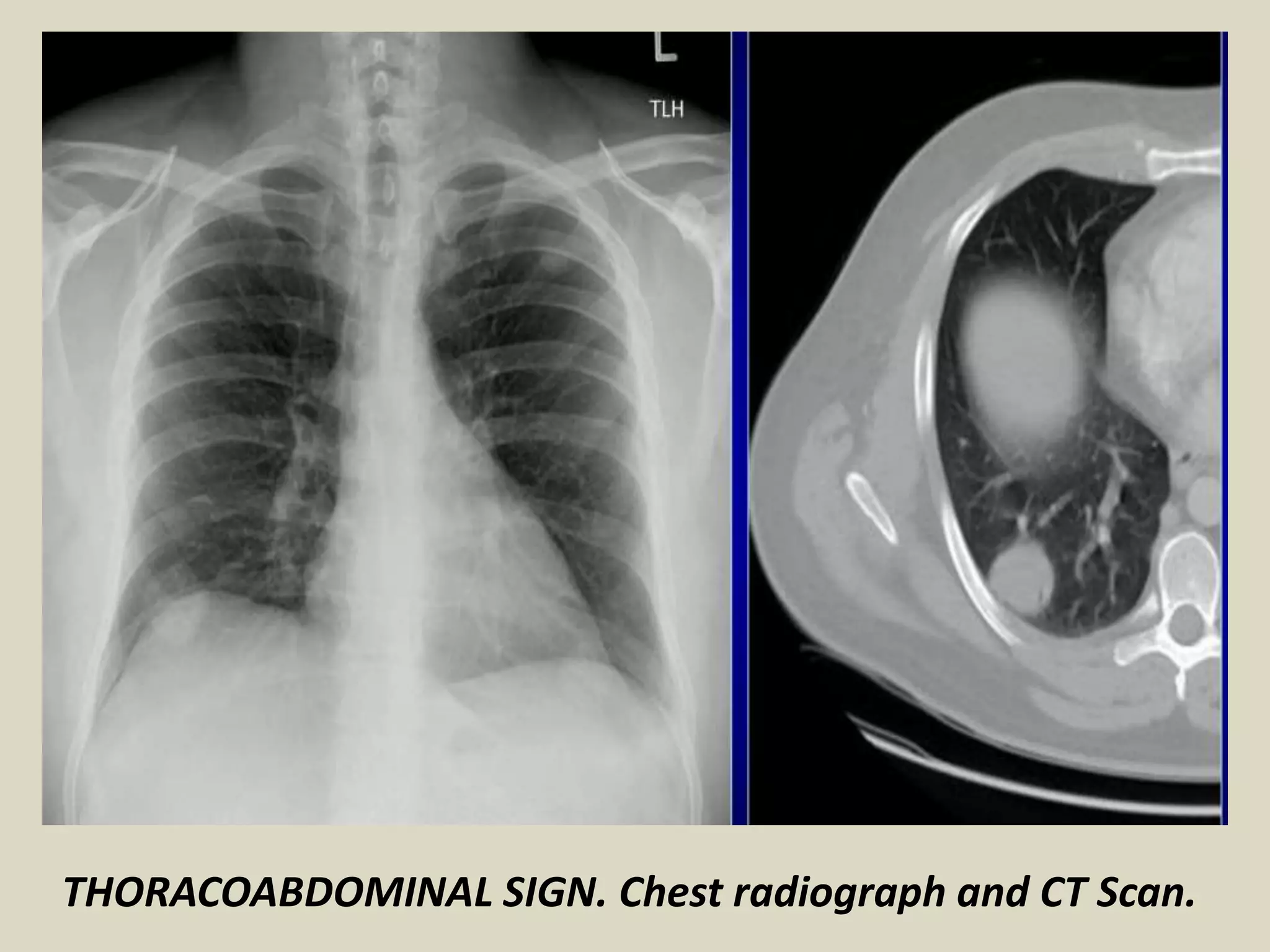 THORACOABDOMINAL SIGN. Chest radiograph and CT Scan.
 