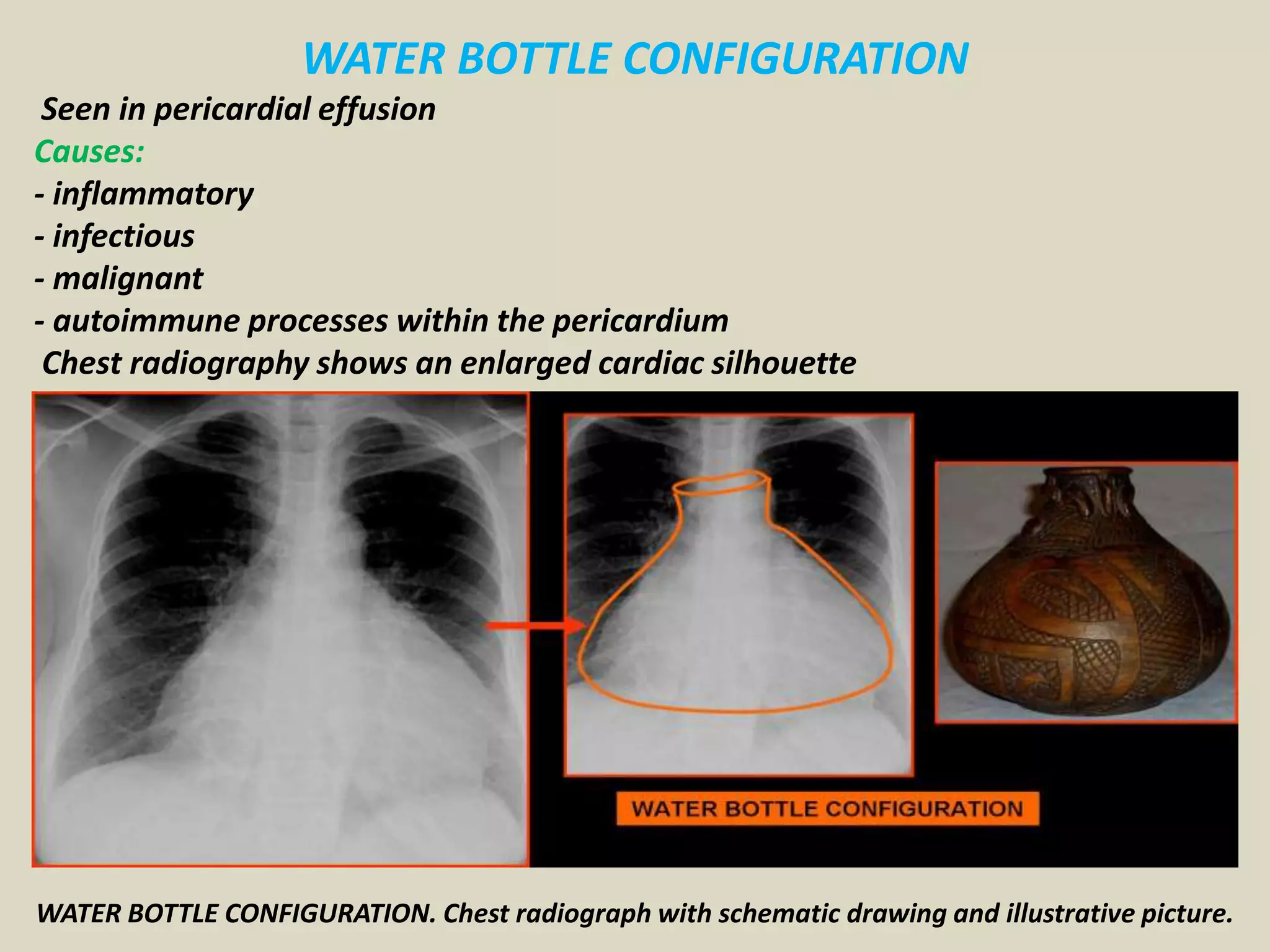 WATER BOTTLE CONFIGURATION
Seen in pericardial effusion
Causes:
- inflammatory
- infectious
- malignant
- autoimmune processes within the pericardium
Chest radiography shows an enlarged cardiac silhouette
WATER BOTTLE CONFIGURATION. Chest radiograph with schematic drawing and illustrative picture.
 