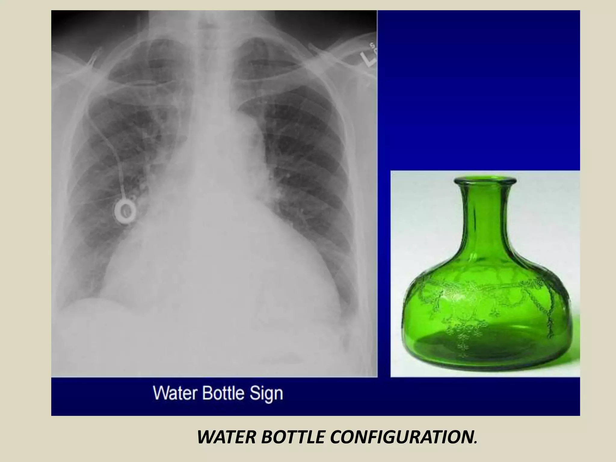 WATER BOTTLE CONFIGURATION.
 