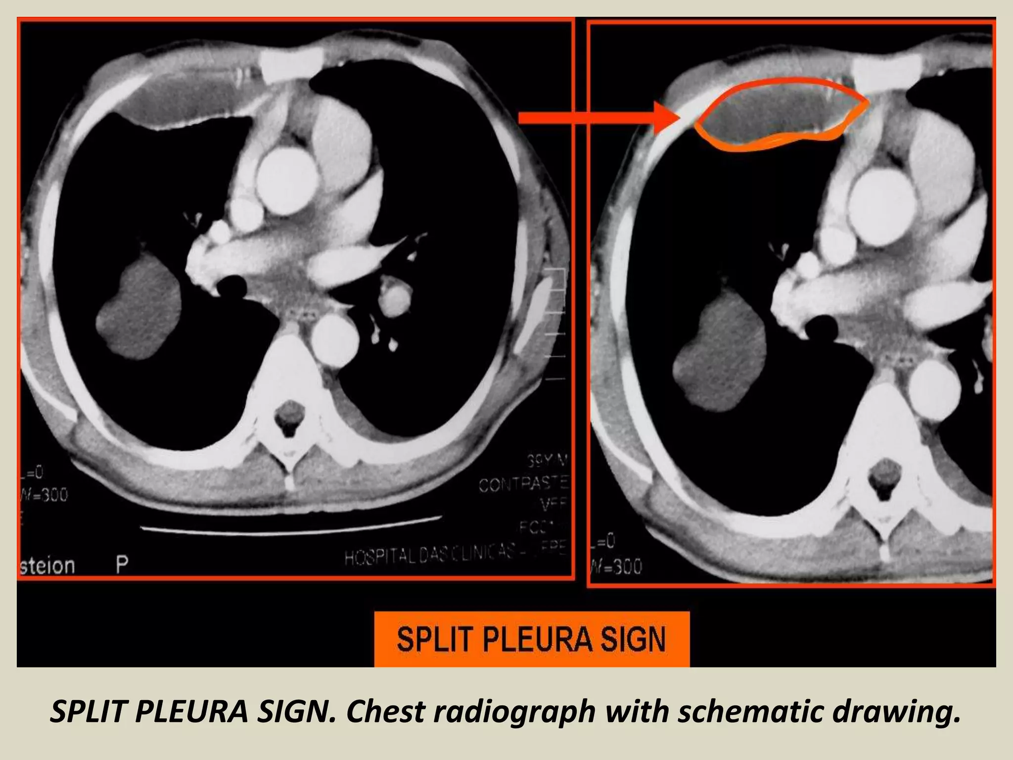 SPLIT PLEURA SIGN. Chest radiograph with schematic drawing.
 