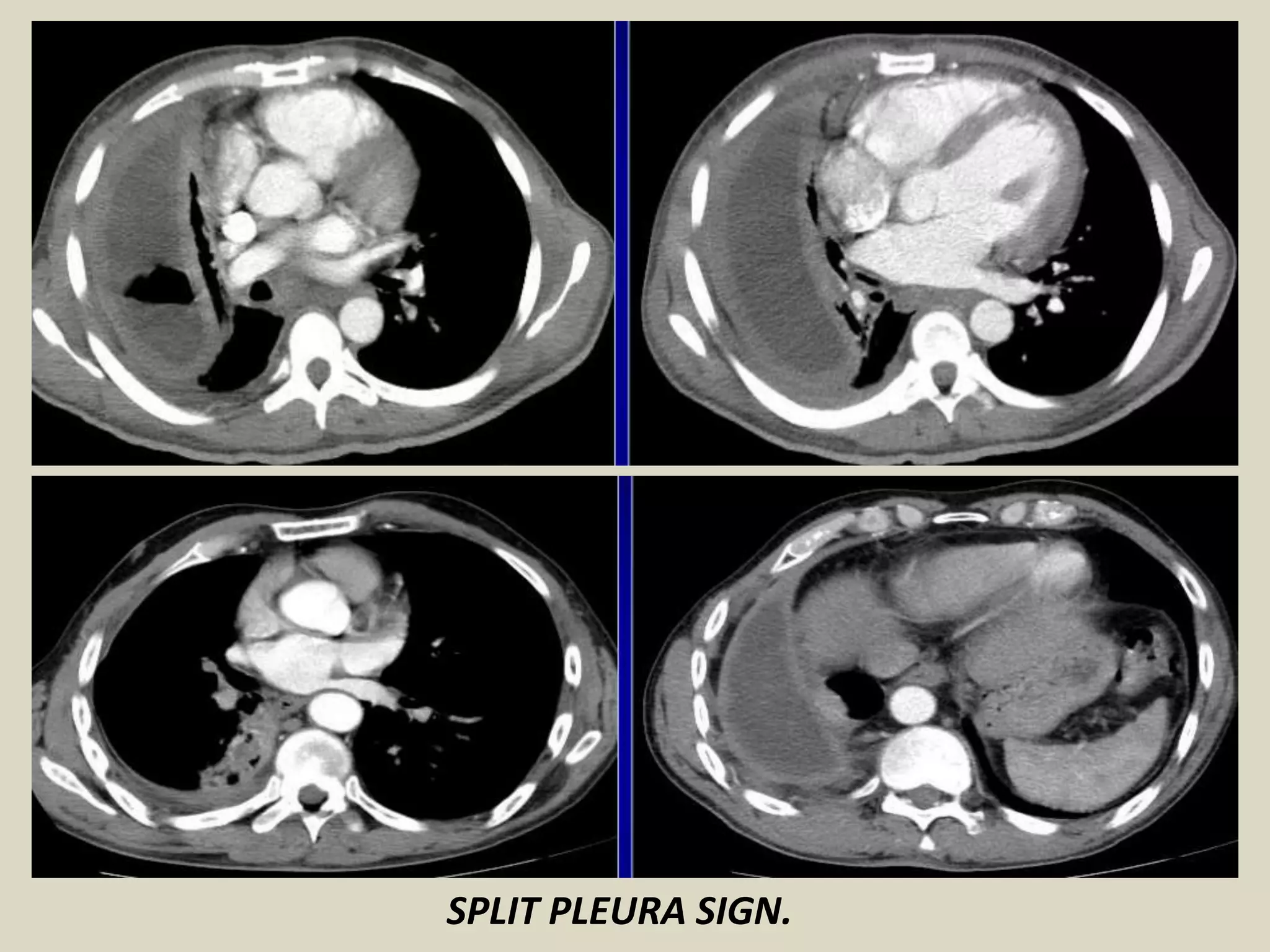 SPLIT PLEURA SIGN.
 
