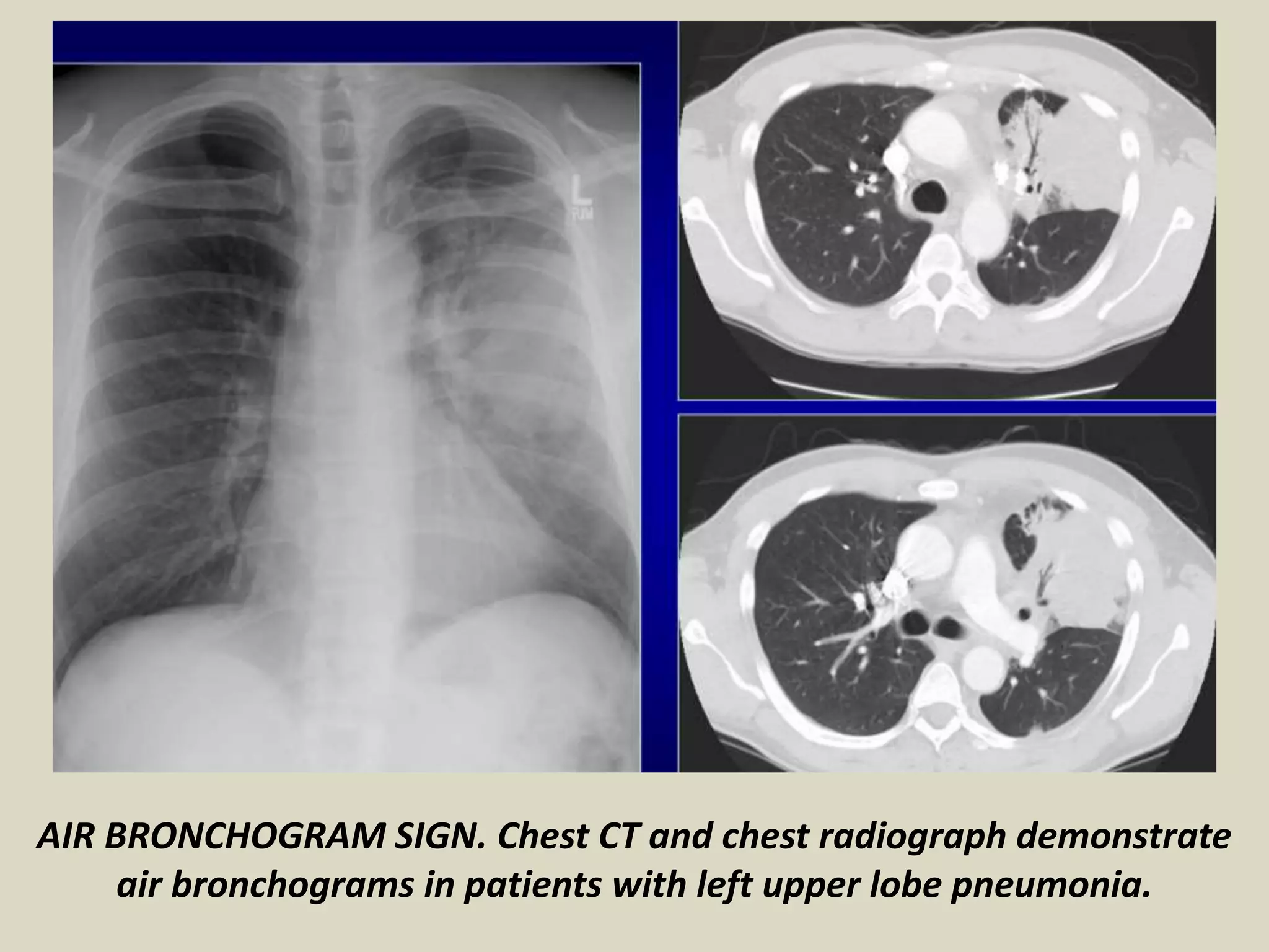 AIR BRONCHOGRAM SIGN. Chest CT and chest radiograph demonstrate
air bronchograms in patients with left upper lobe pneumonia.
 