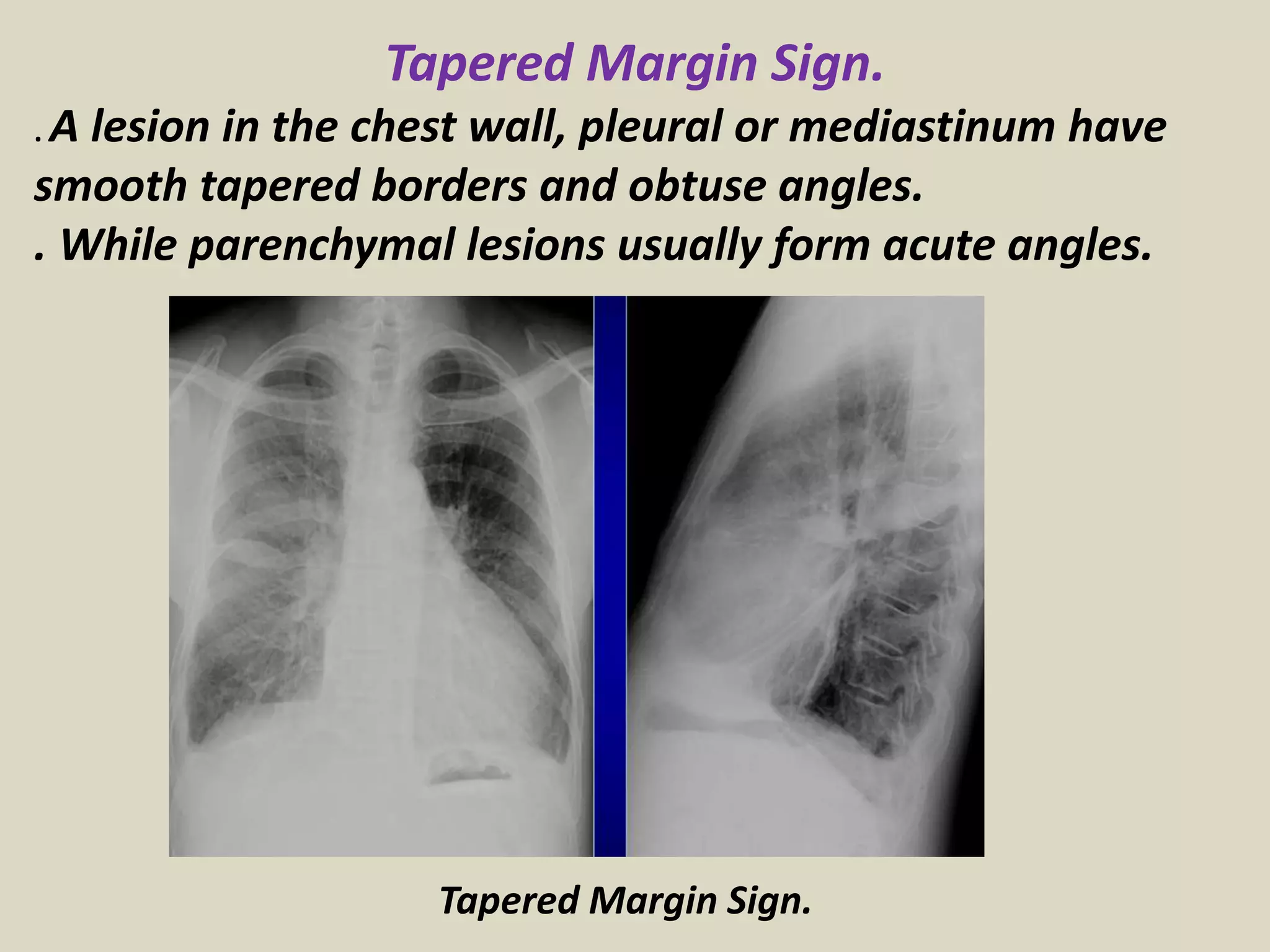 Tapered Margin Sign.
. A lesion in the chest wall, pleural or mediastinum have
smooth tapered borders and obtuse angles.
. While parenchymal lesions usually form acute angles.
Tapered Margin Sign.
 