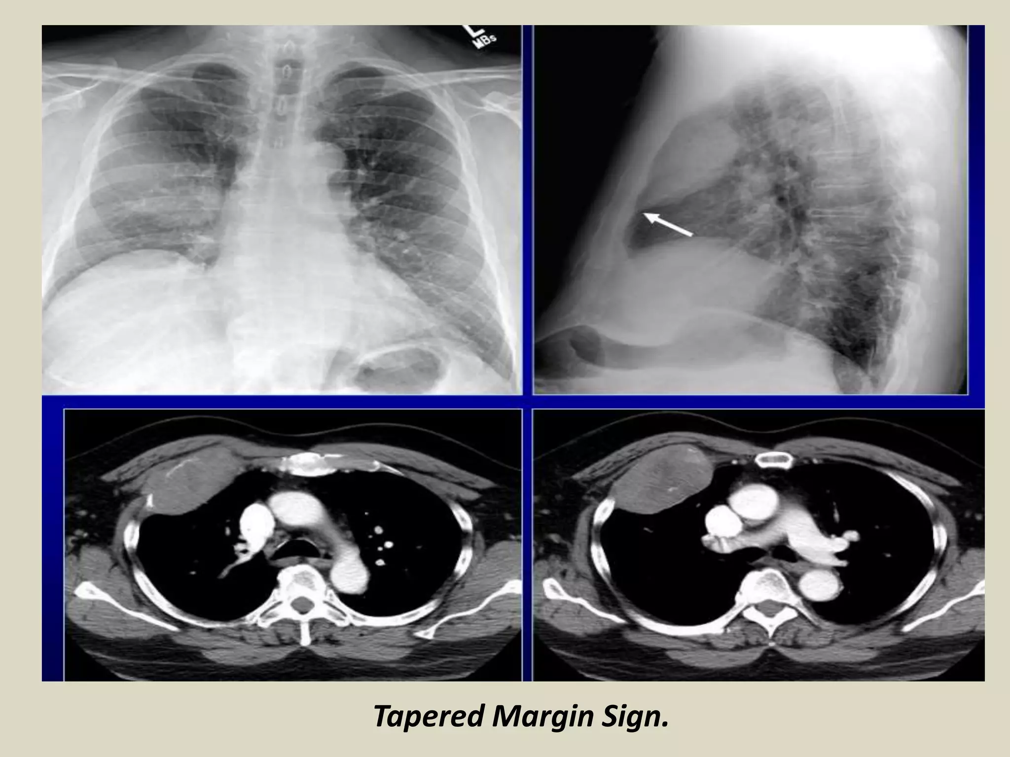 Tapered Margin Sign.
 
