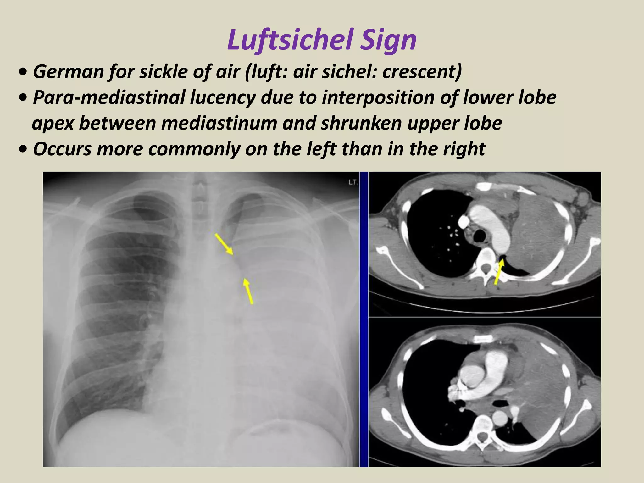 Luftsichel Sign
• German for sickle of air (luft: air sichel: crescent)
• Para-mediastinal lucency due to interposition of lower lobe
apex between mediastinum and shrunken upper lobe
• Occurs more commonly on the left than in the right
 