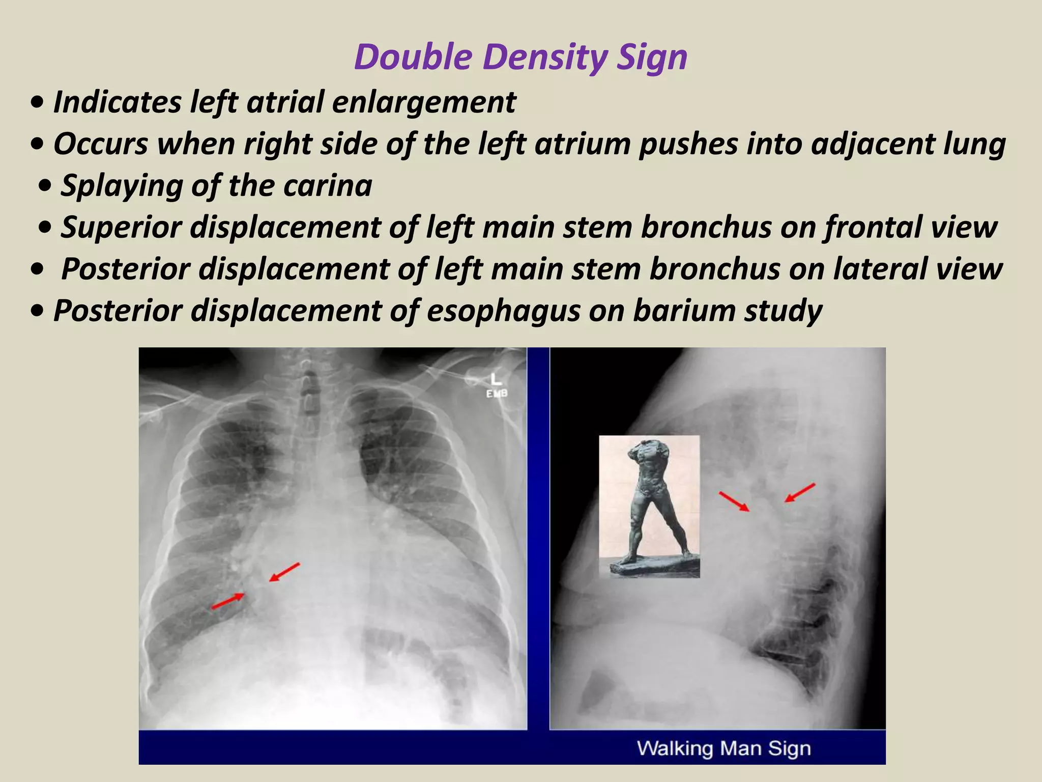 Double Density Sign
• Indicates left atrial enlargement
• Occurs when right side of the left atrium pushes into adjacent lung
• Splaying of the carina
• Superior displacement of left main stem bronchus on frontal view
• Posterior displacement of left main stem bronchus on lateral view
• Posterior displacement of esophagus on barium study
 