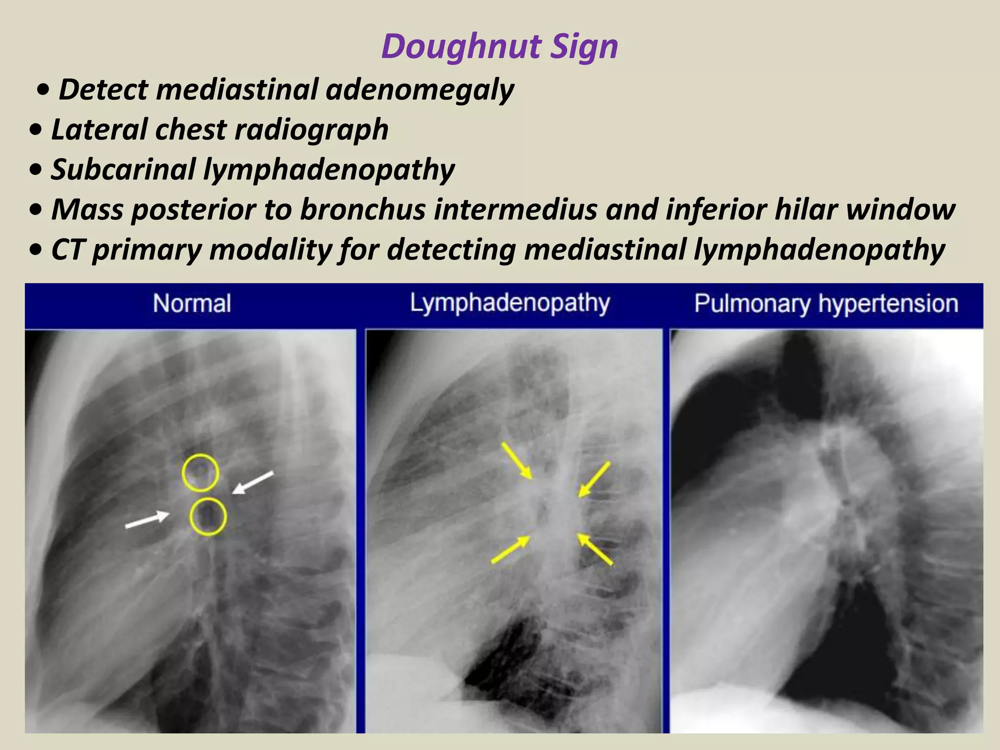 Doughnut Sign
• Detect mediastinal adenomegaly
• Lateral chest radiograph
• Subcarinal lymphadenopathy
• Mass posterior to bronchus intermedius and inferior hilar window
• CT primary modality for detecting mediastinal lymphadenopathy
 