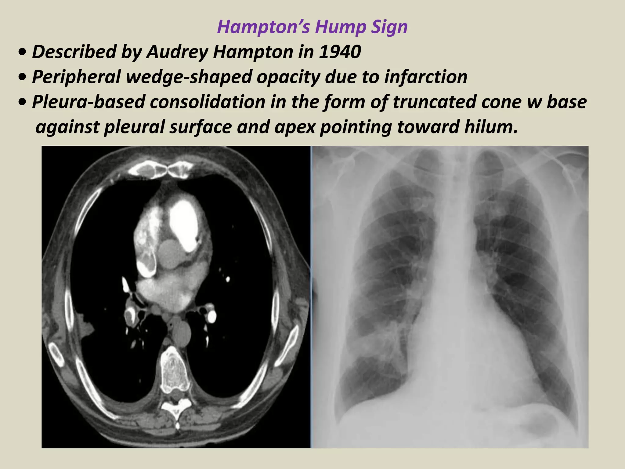 Hampton’s Hump Sign
• Described by Audrey Hampton in 1940
• Peripheral wedge-shaped opacity due to infarction
• Pleura-based consolidation in the form of truncated cone w base
against pleural surface and apex pointing toward hilum.
 
