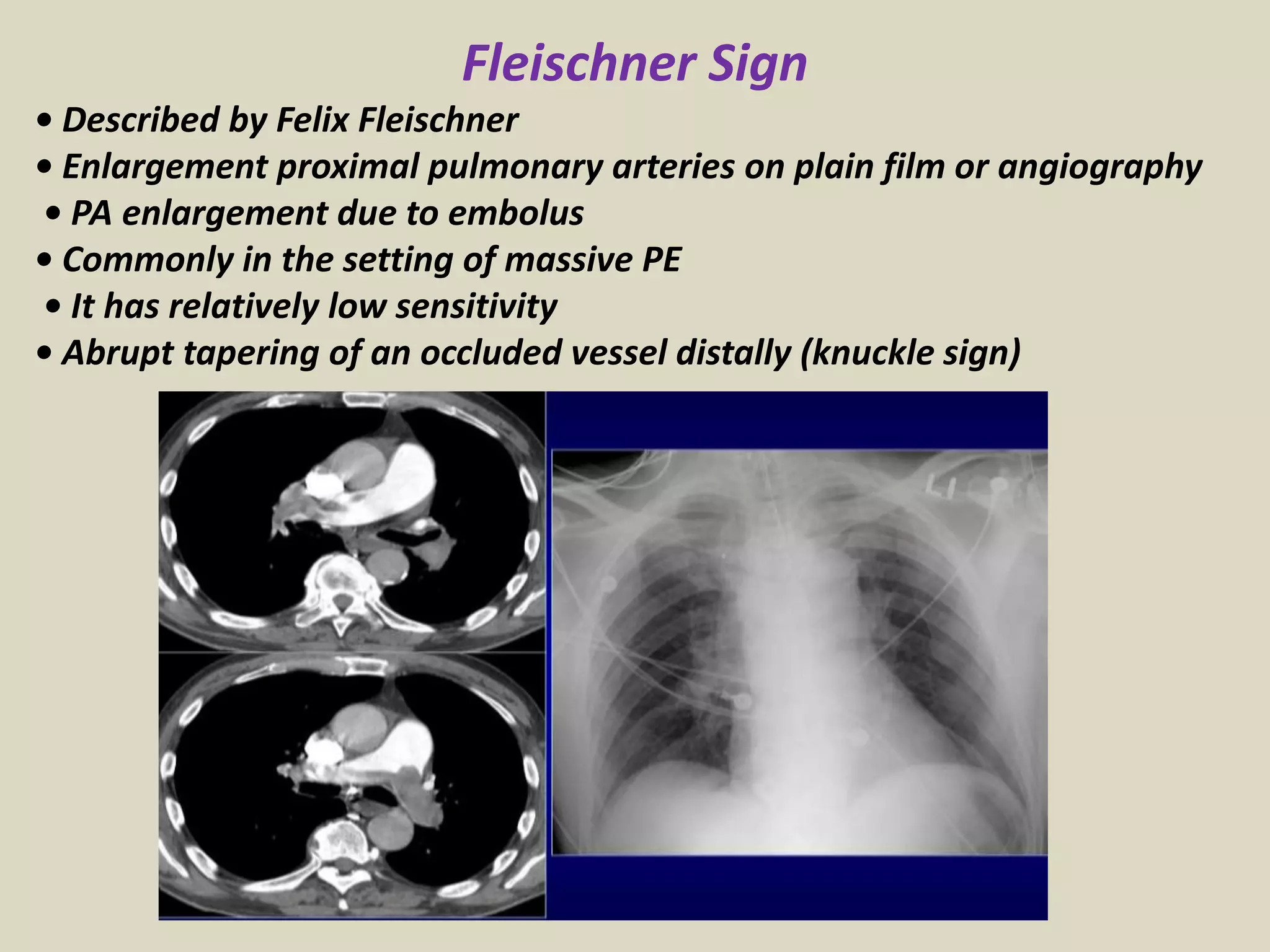 Fleischner Sign
• Described by Felix Fleischner
• Enlargement proximal pulmonary arteries on plain film or angiography
• PA enlargement due to embolus
• Commonly in the setting of massive PE
• It has relatively low sensitivity
• Abrupt tapering of an occluded vessel distally (knuckle sign)
 