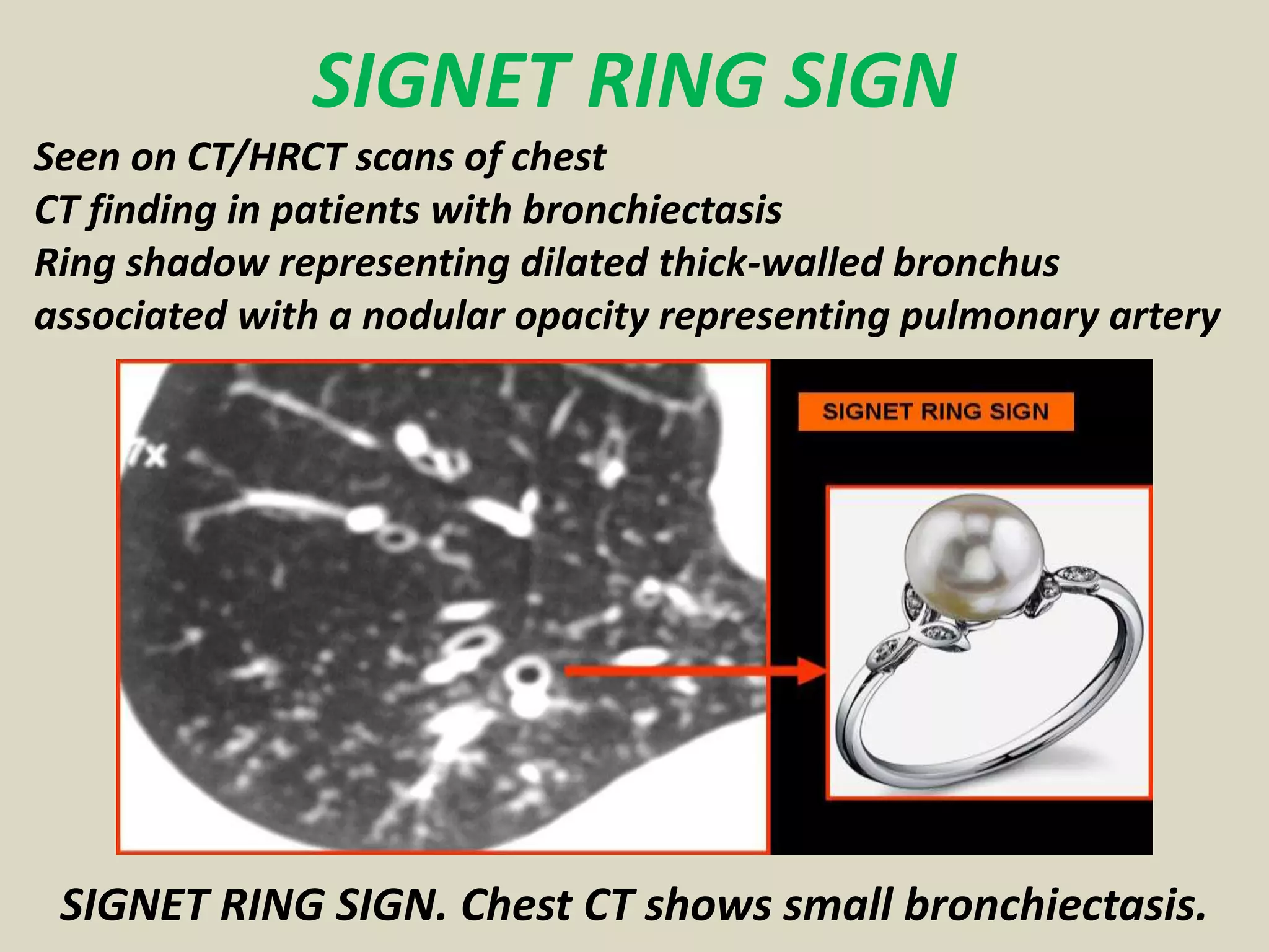 SIGNET RING SIGN
Seen on CT/HRCT scans of chest
CT finding in patients with bronchiectasis
Ring shadow representing dilated thick-walled bronchus
associated with a nodular opacity representing pulmonary artery
SIGNET RING SIGN. Chest CT shows small bronchiectasis.
 