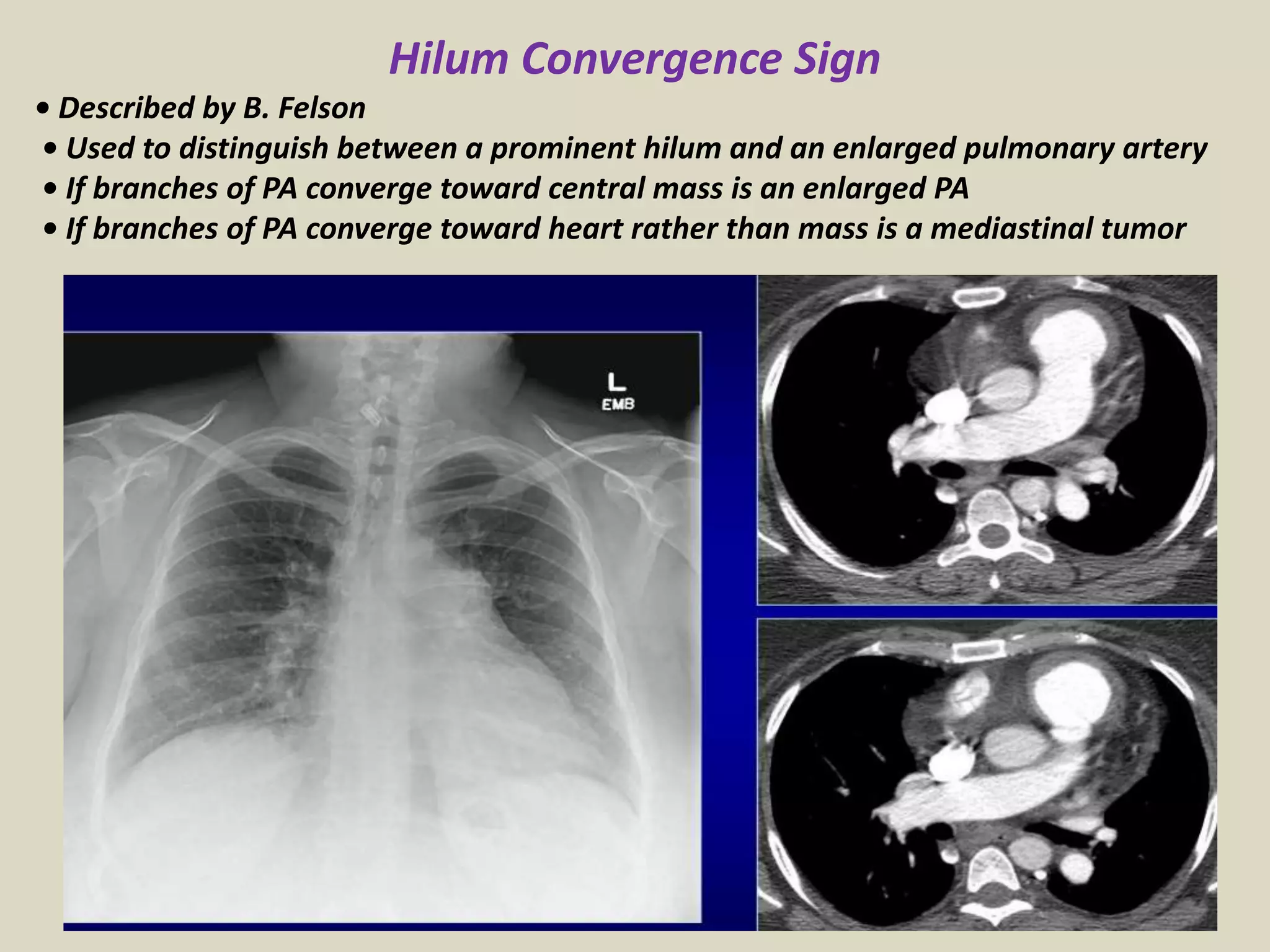 Hilum Convergence Sign
• Described by B. Felson
• Used to distinguish between a prominent hilum and an enlarged pulmonary artery
• If branches of PA converge toward central mass is an enlarged PA
• If branches of PA converge toward heart rather than mass is a mediastinal tumor
 