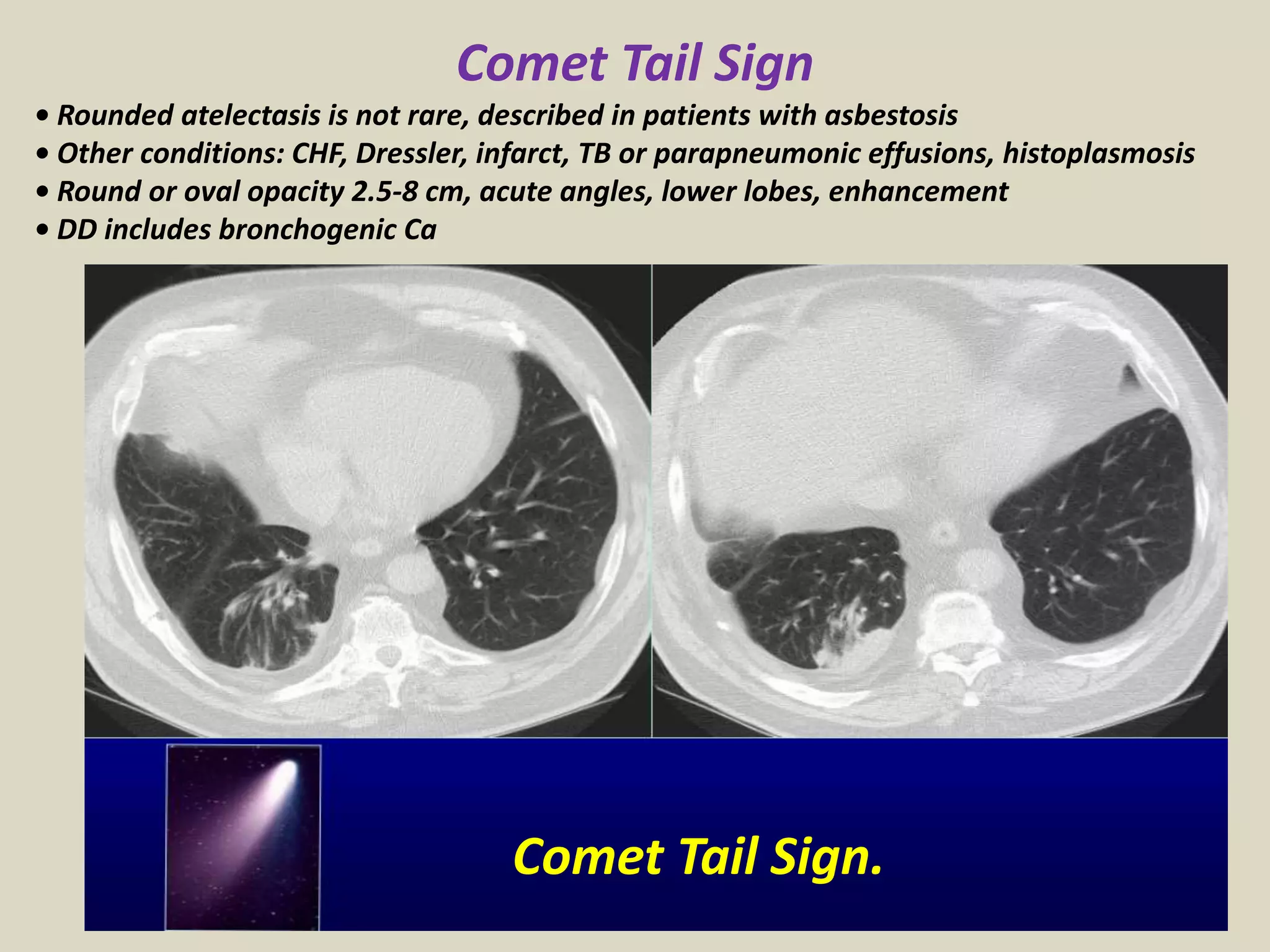Comet Tail Sign
• Rounded atelectasis is not rare, described in patients with asbestosis
• Other conditions: CHF, Dressler, infarct, TB or parapneumonic effusions, histoplasmosis
• Round or oval opacity 2.5-8 cm, acute angles, lower lobes, enhancement
• DD includes bronchogenic Ca
Comet Tail Sign.
 