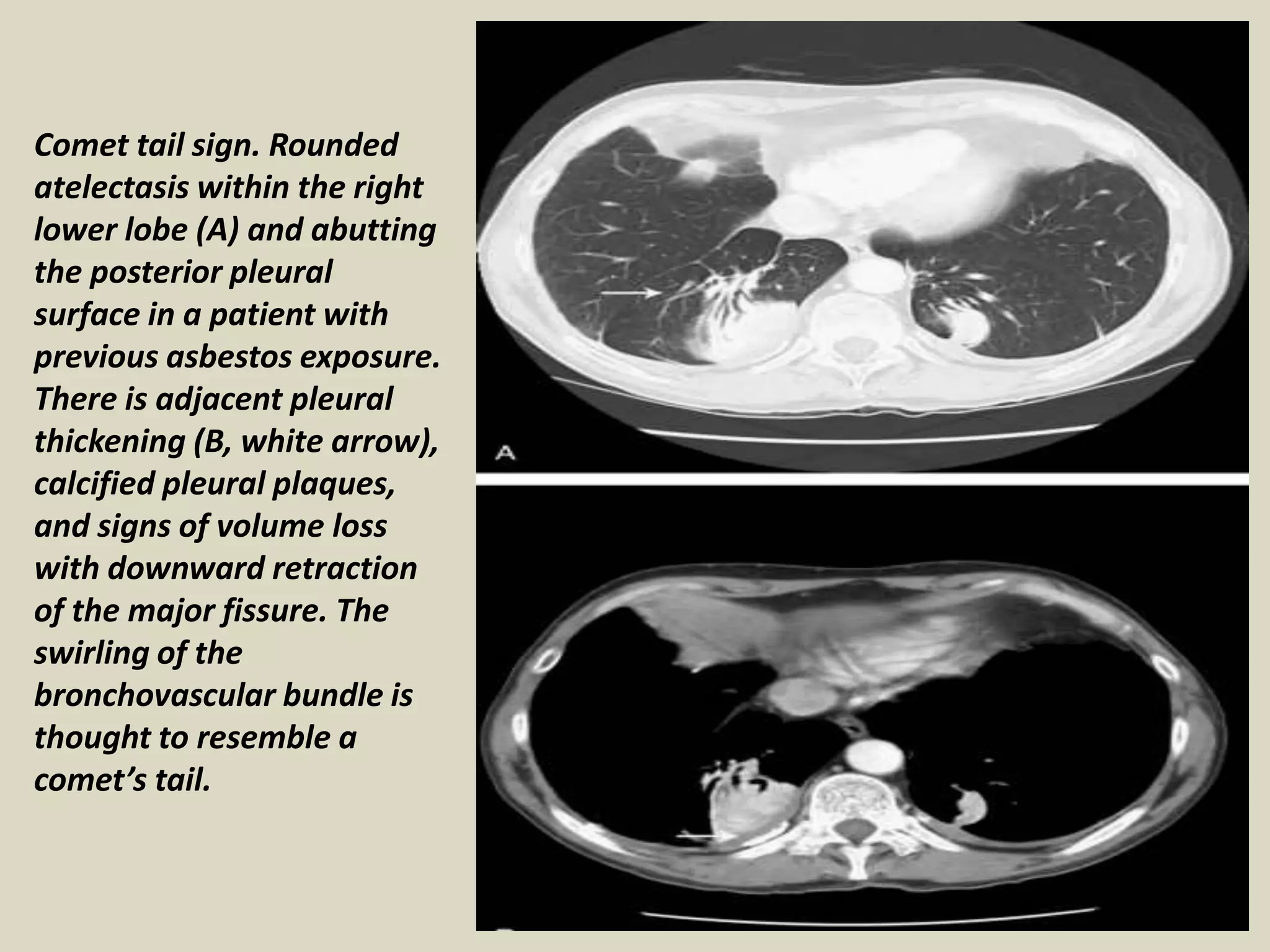 Comet tail sign. Rounded
atelectasis within the right
lower lobe (A) and abutting
the posterior pleural
surface in a patient with
previous asbestos exposure.
There is adjacent pleural
thickening (B, white arrow),
calcified pleural plaques,
and signs of volume loss
with downward retraction
of the major fissure. The
swirling of the
bronchovascular bundle is
thought to resemble a
comet’s tail.
 