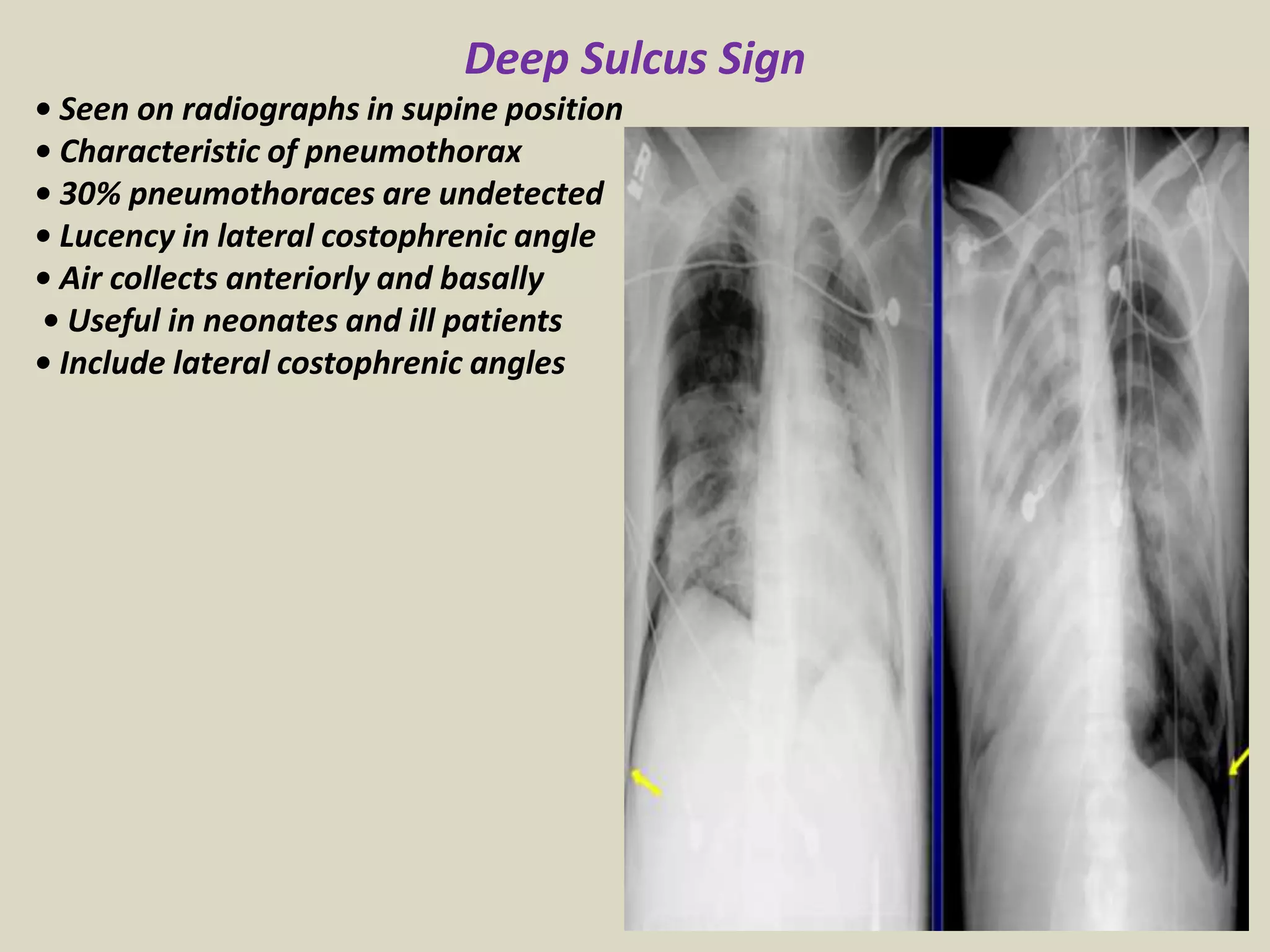 Deep Sulcus Sign
• Seen on radiographs in supine position
• Characteristic of pneumothorax
• 30% pneumothoraces are undetected
• Lucency in lateral costophrenic angle
• Air collects anteriorly and basally
• Useful in neonates and ill patients
• Include lateral costophrenic angles
 